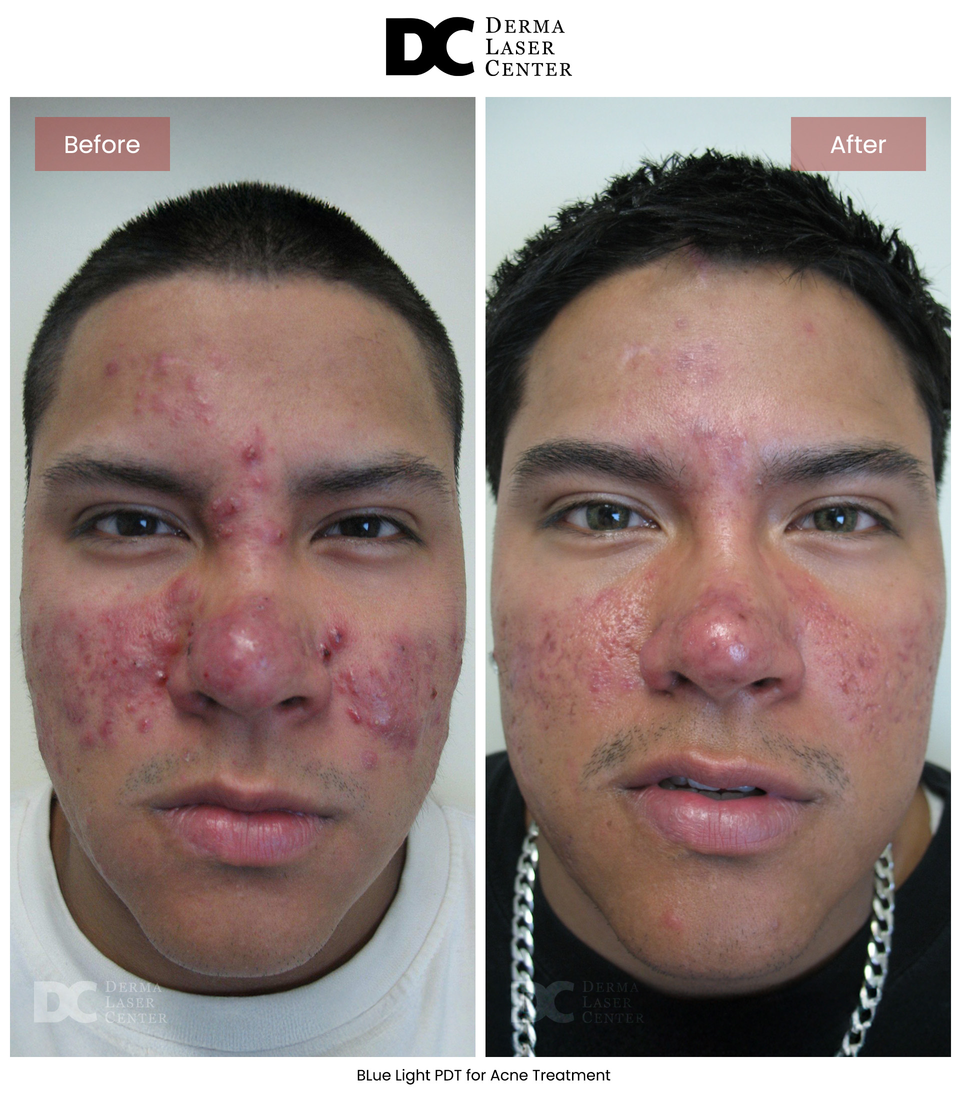 B&A Acne Image 07 V2