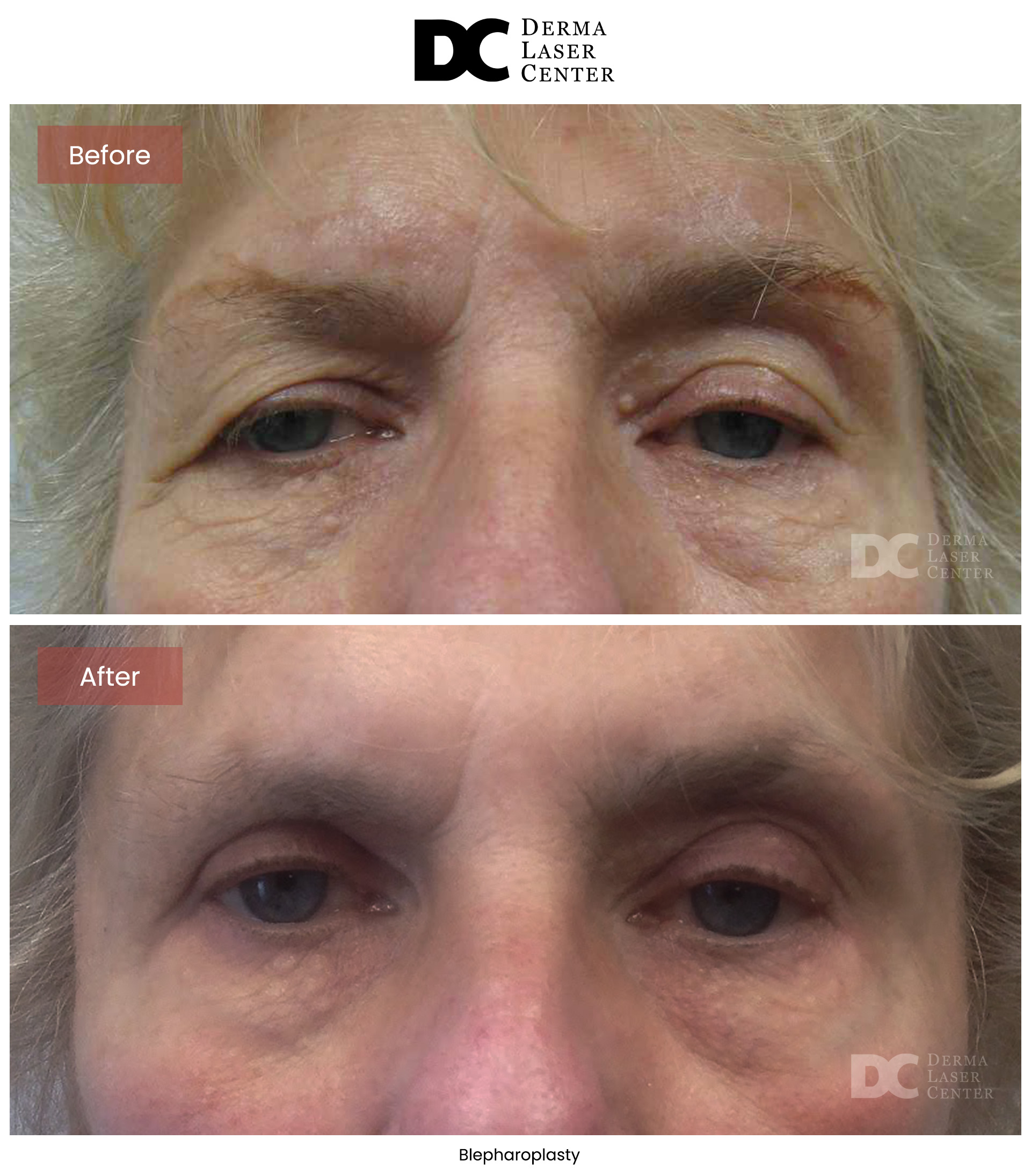 B&A Blepharoplasty Image 01 V1