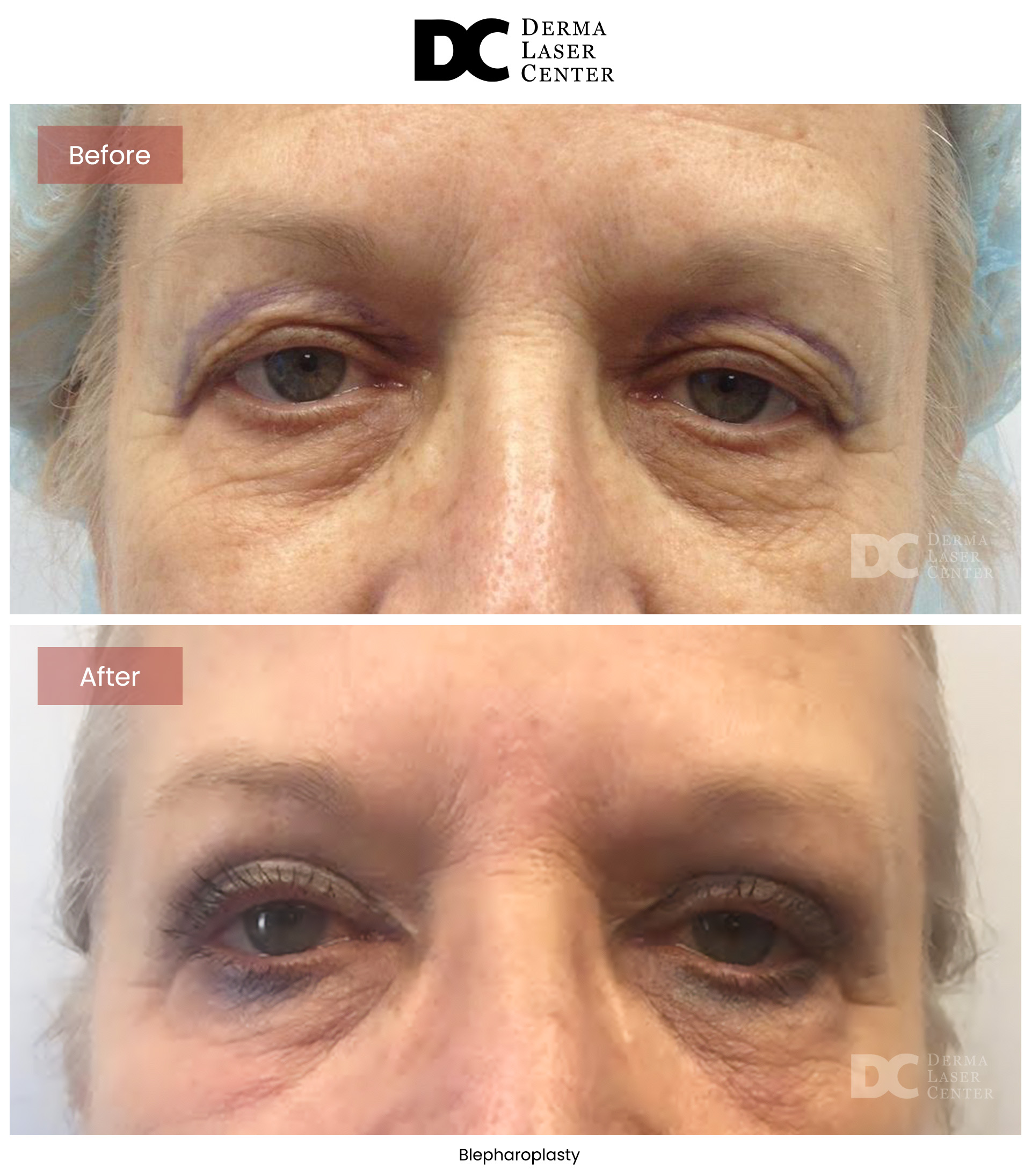 B&A Blepharoplasty Image 02 V1