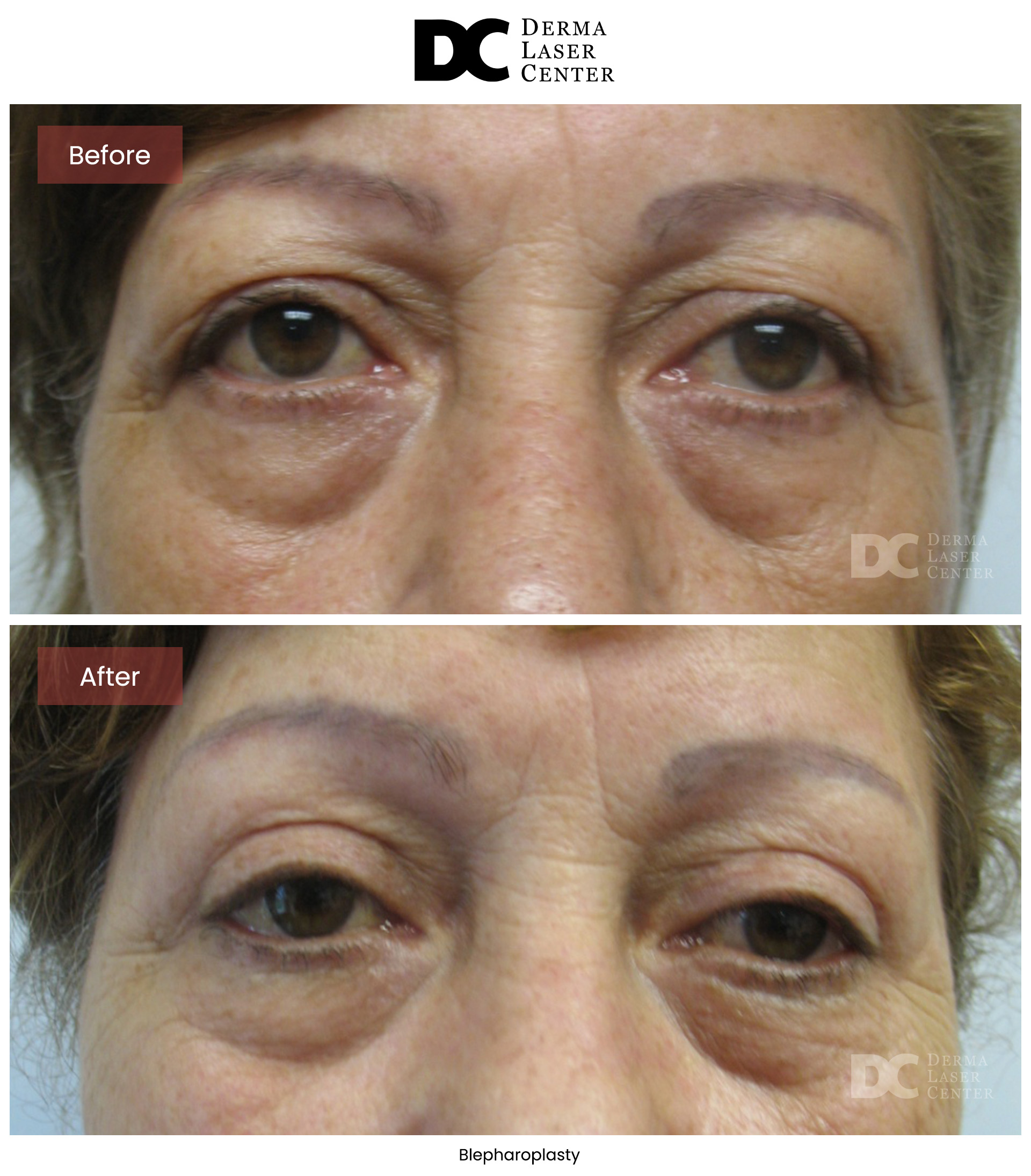 B&A Blepharoplasty Image 03 V1