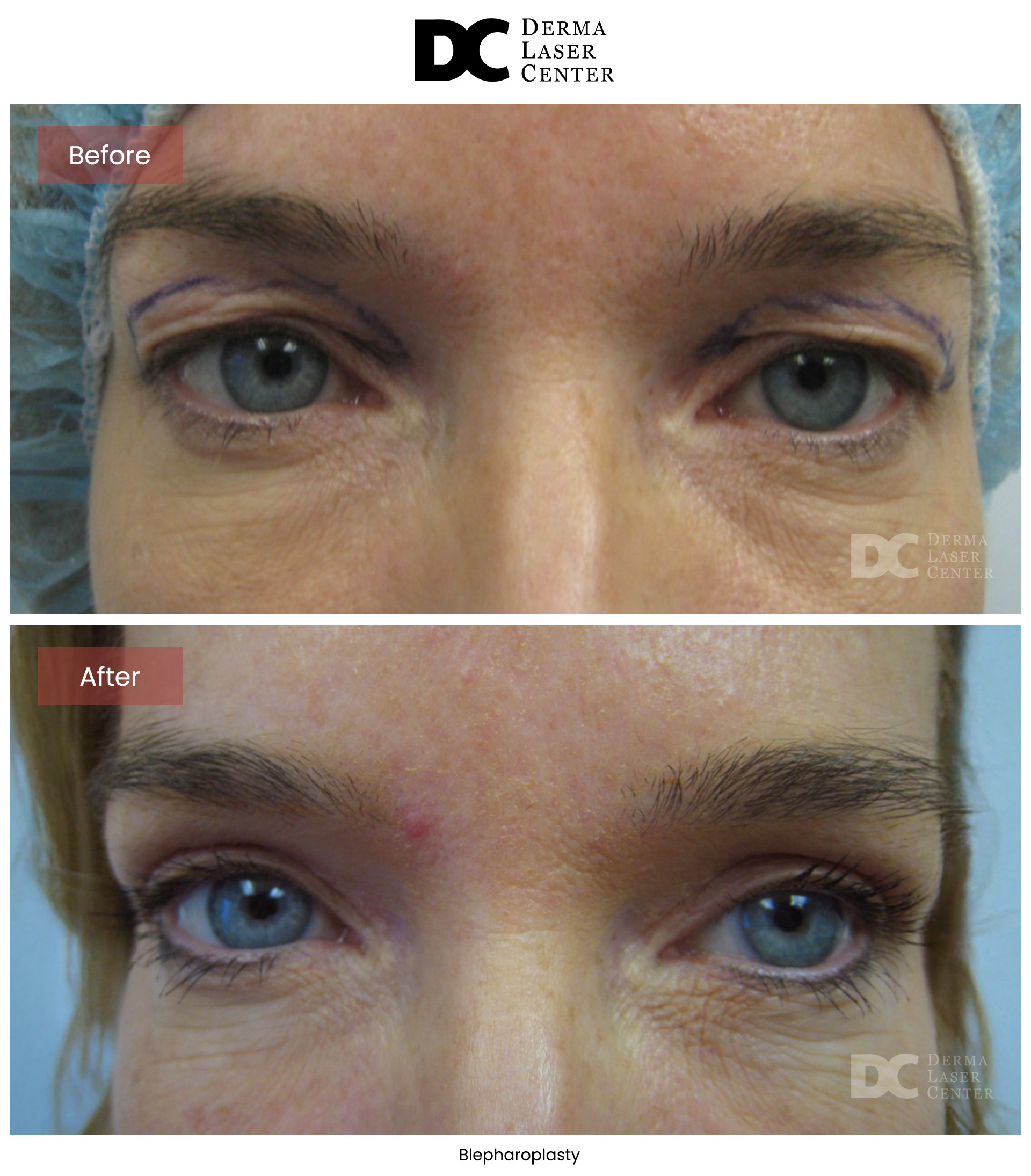 B&A Blepharoplasty Image 04 V1