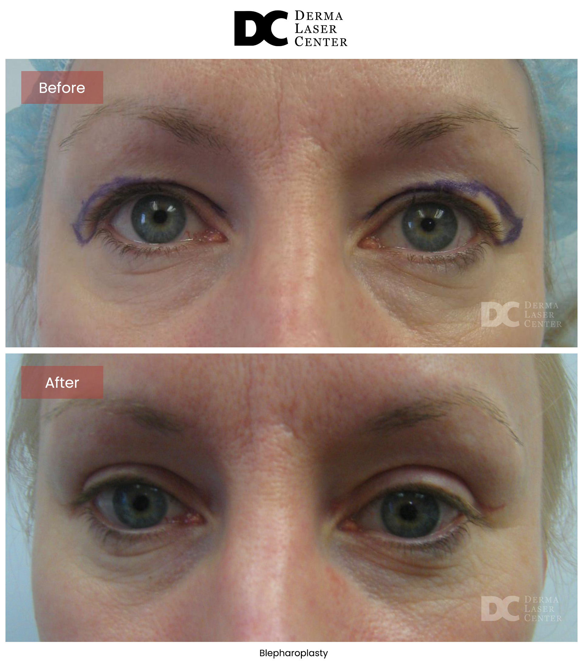 B&A Blepharoplasty Image 05 V1