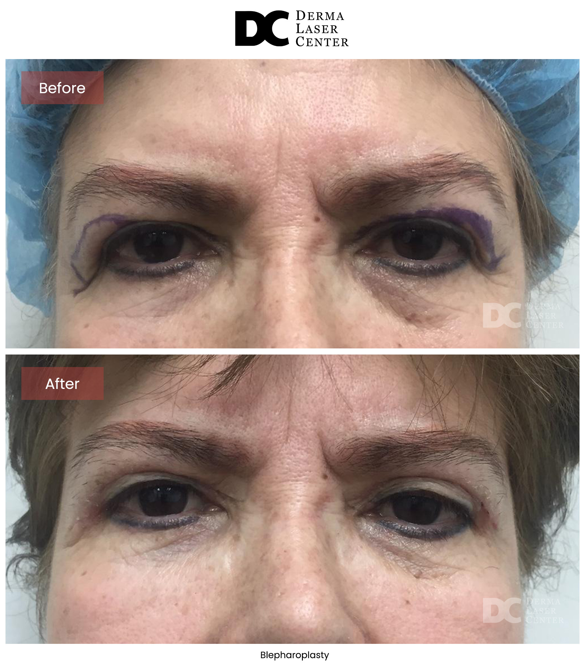 B&A Blepharoplasty Image 06 V1