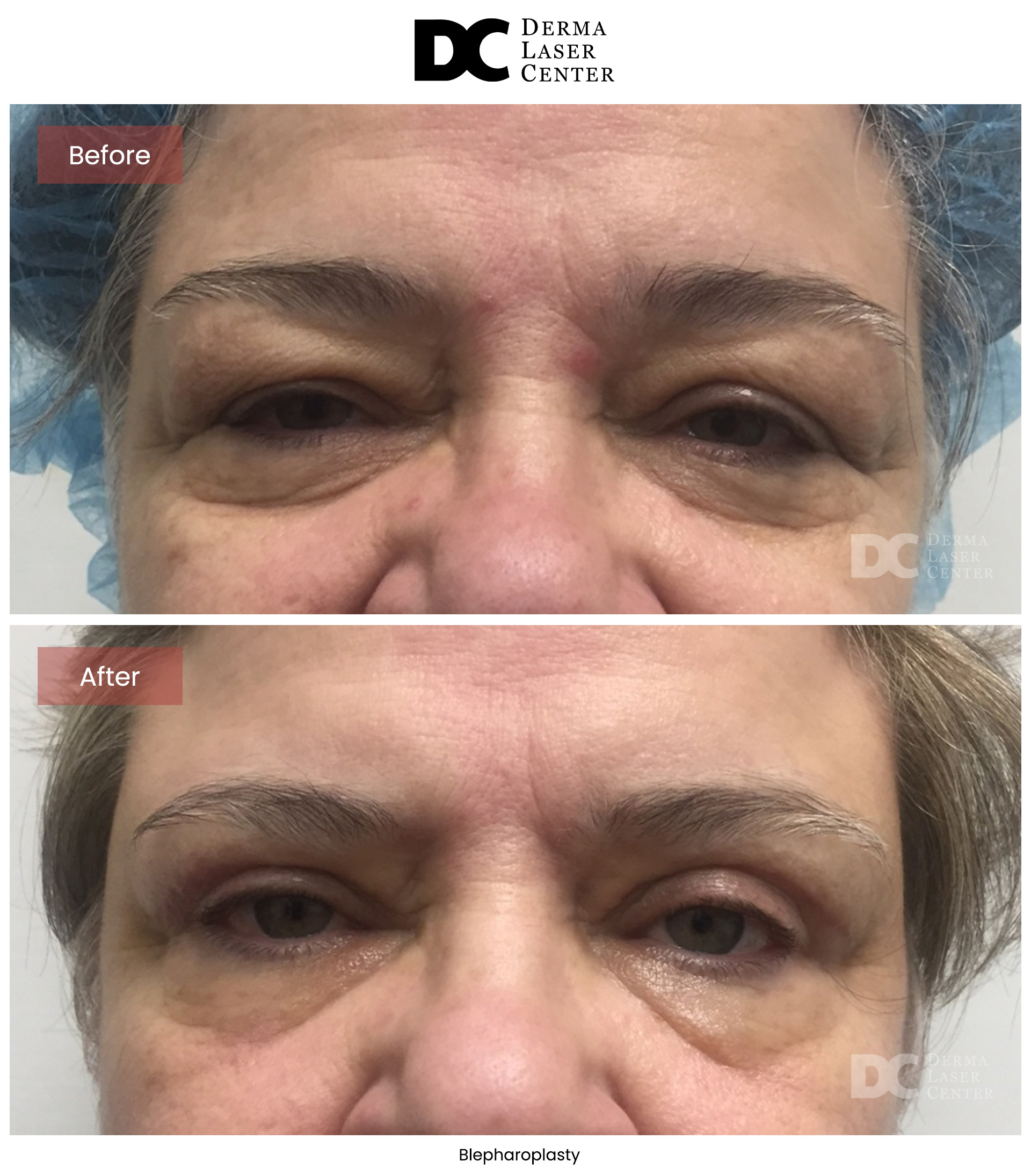 B&A Blepharoplasty Image 07 V1