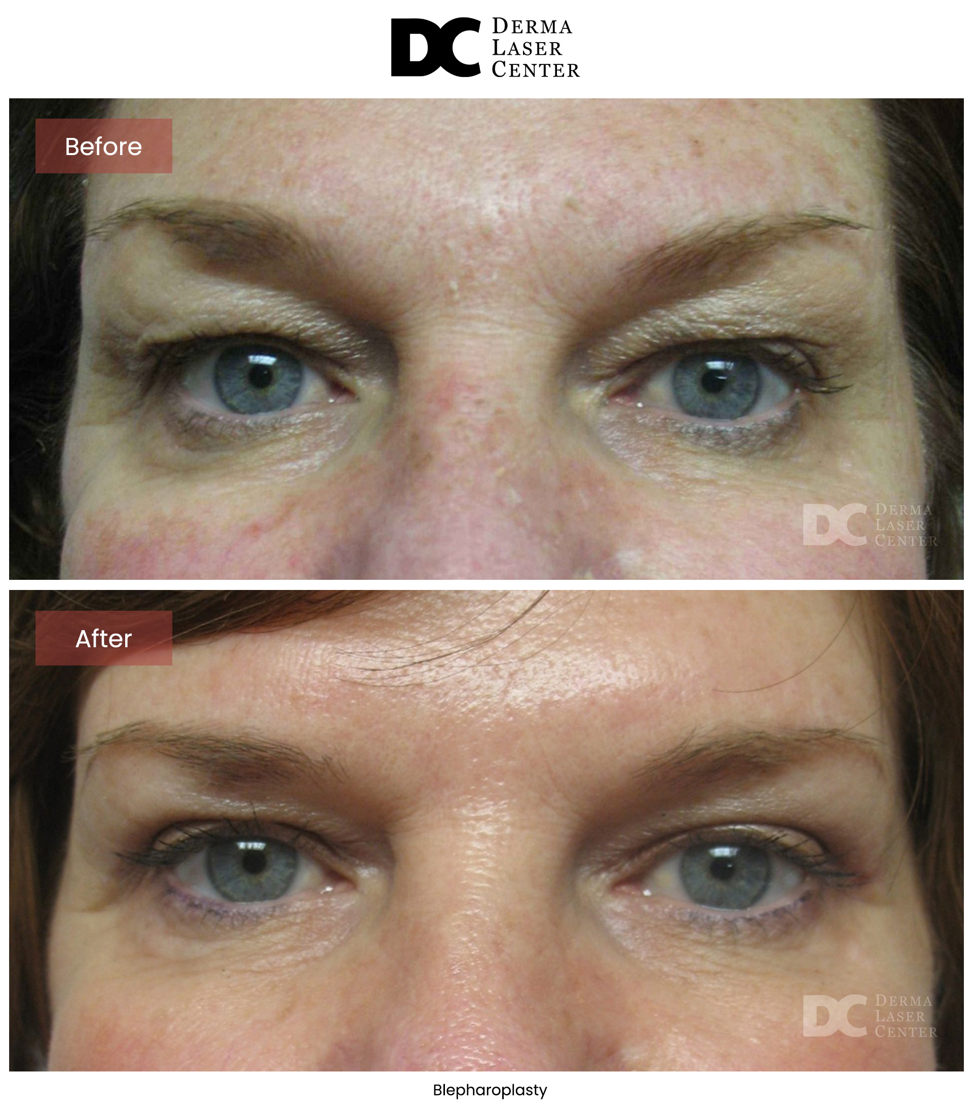B&A Blepharoplasty Image 08 V1