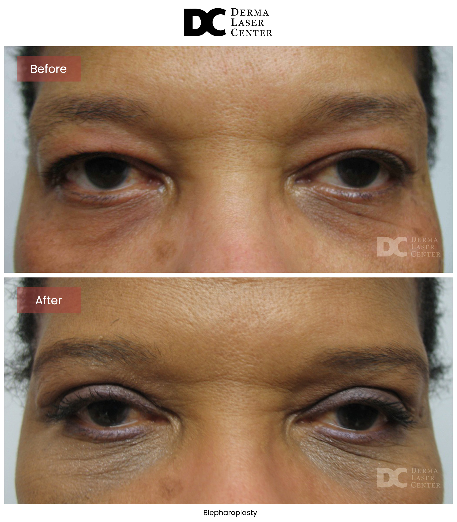 B&A Blepharoplasty Image 09 V1