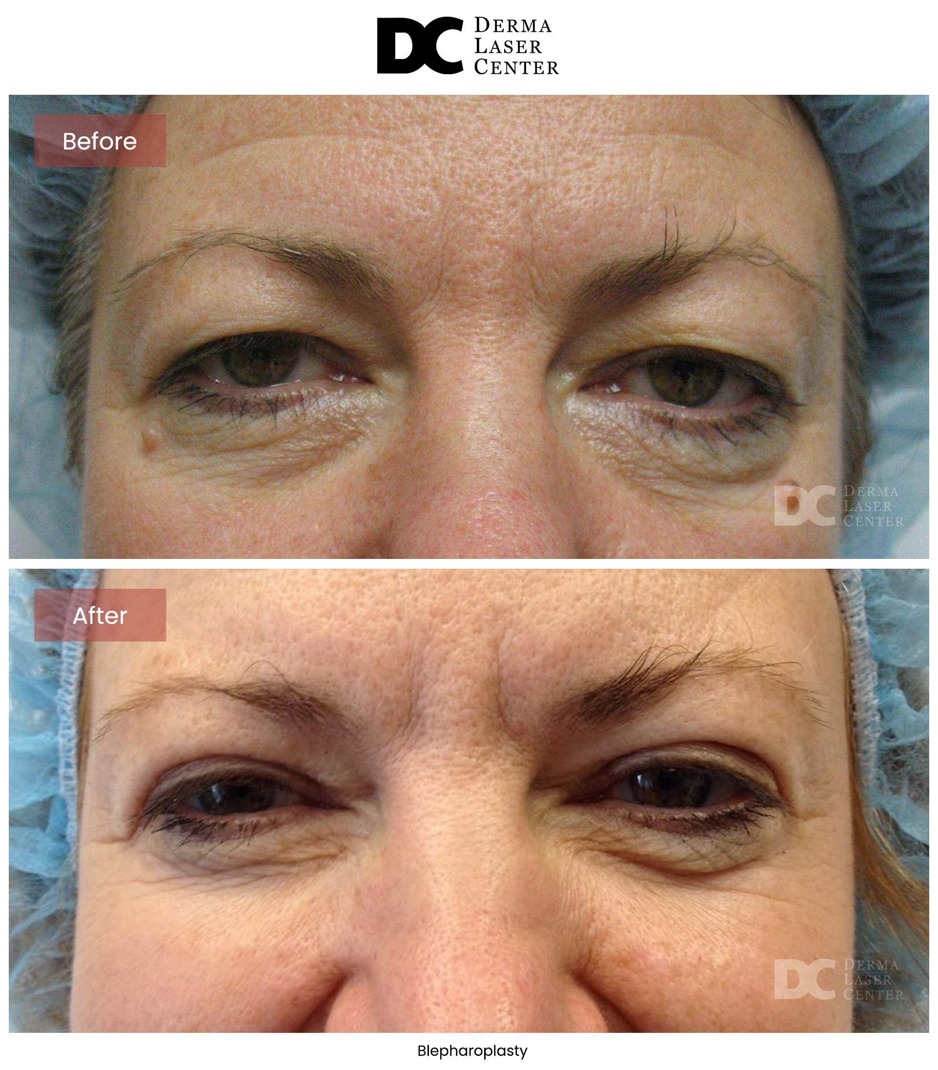 B&A Blepharoplasty Image 10 V1