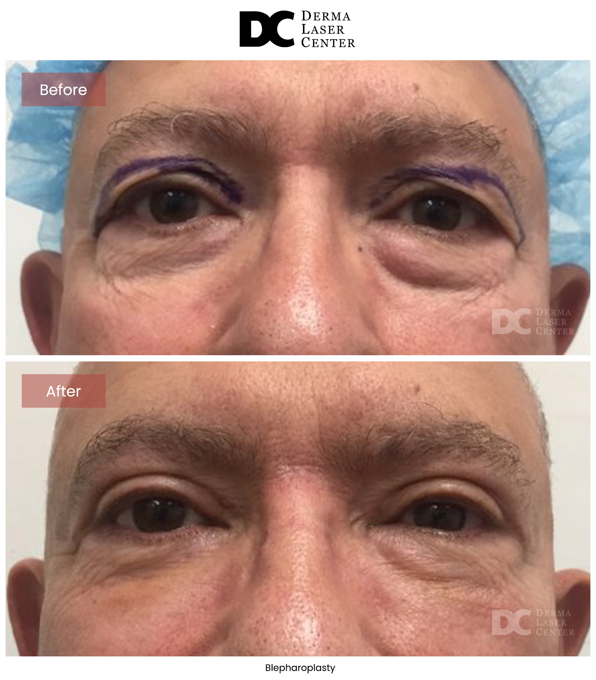 B&A Blepharoplasty Image 11 V1