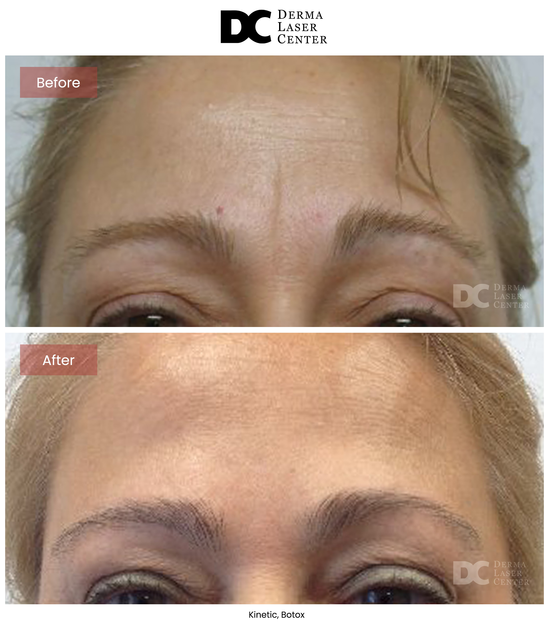 B&A Botox Image 02 V1