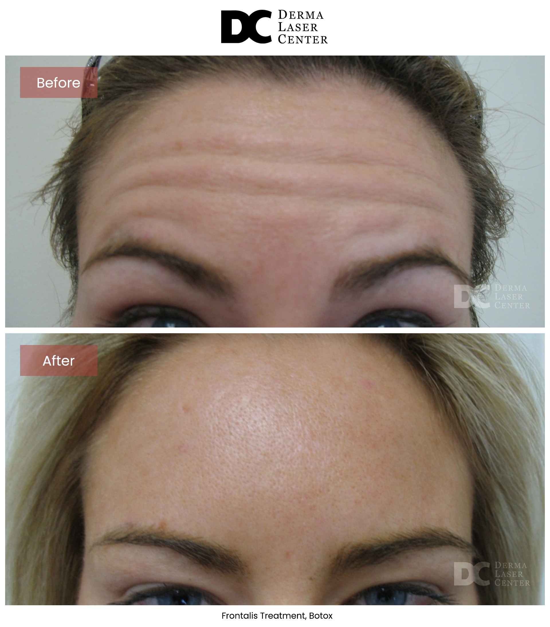 B&A Botox Image 04 V1