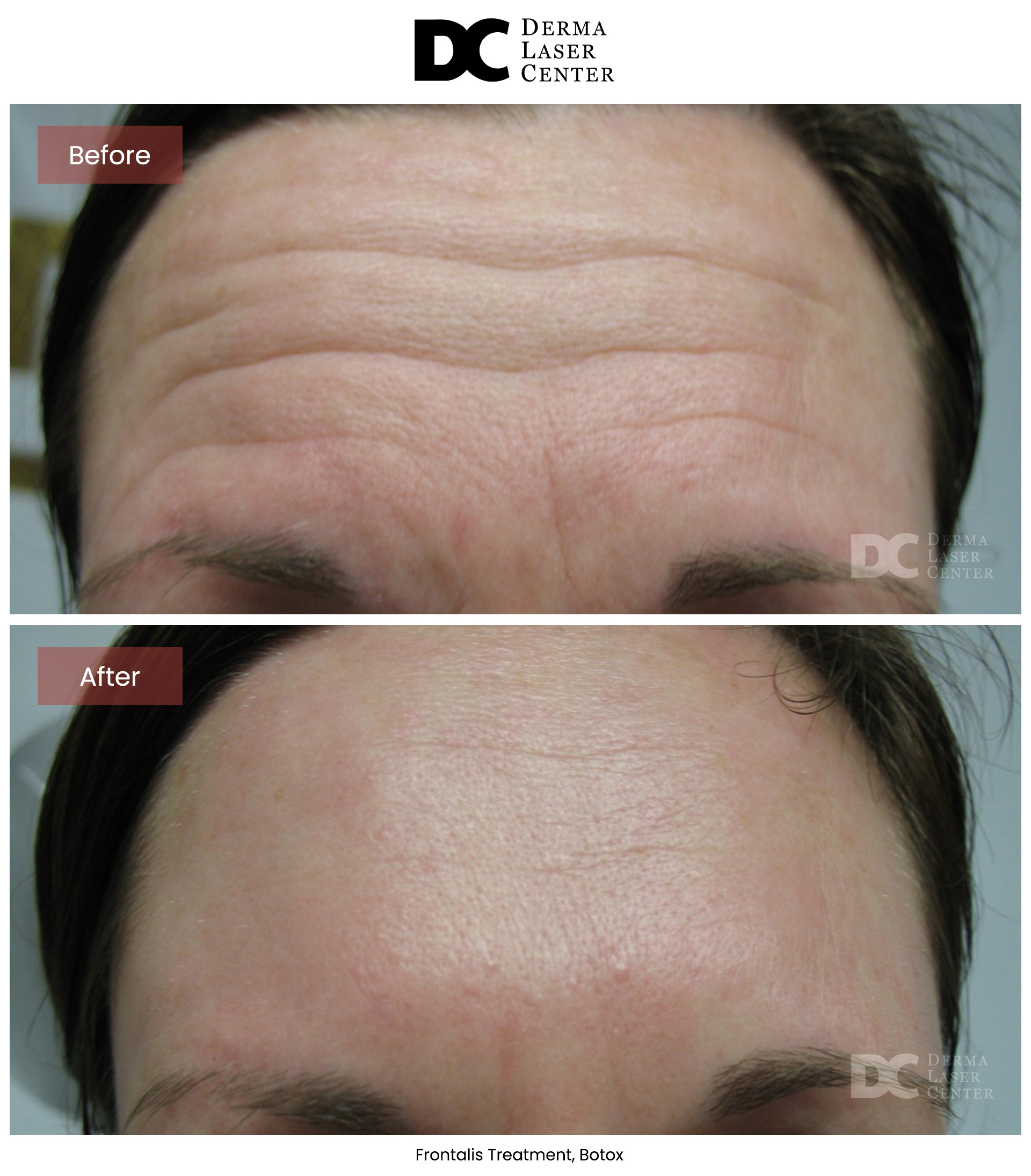 B&A Botox Image 06 V1