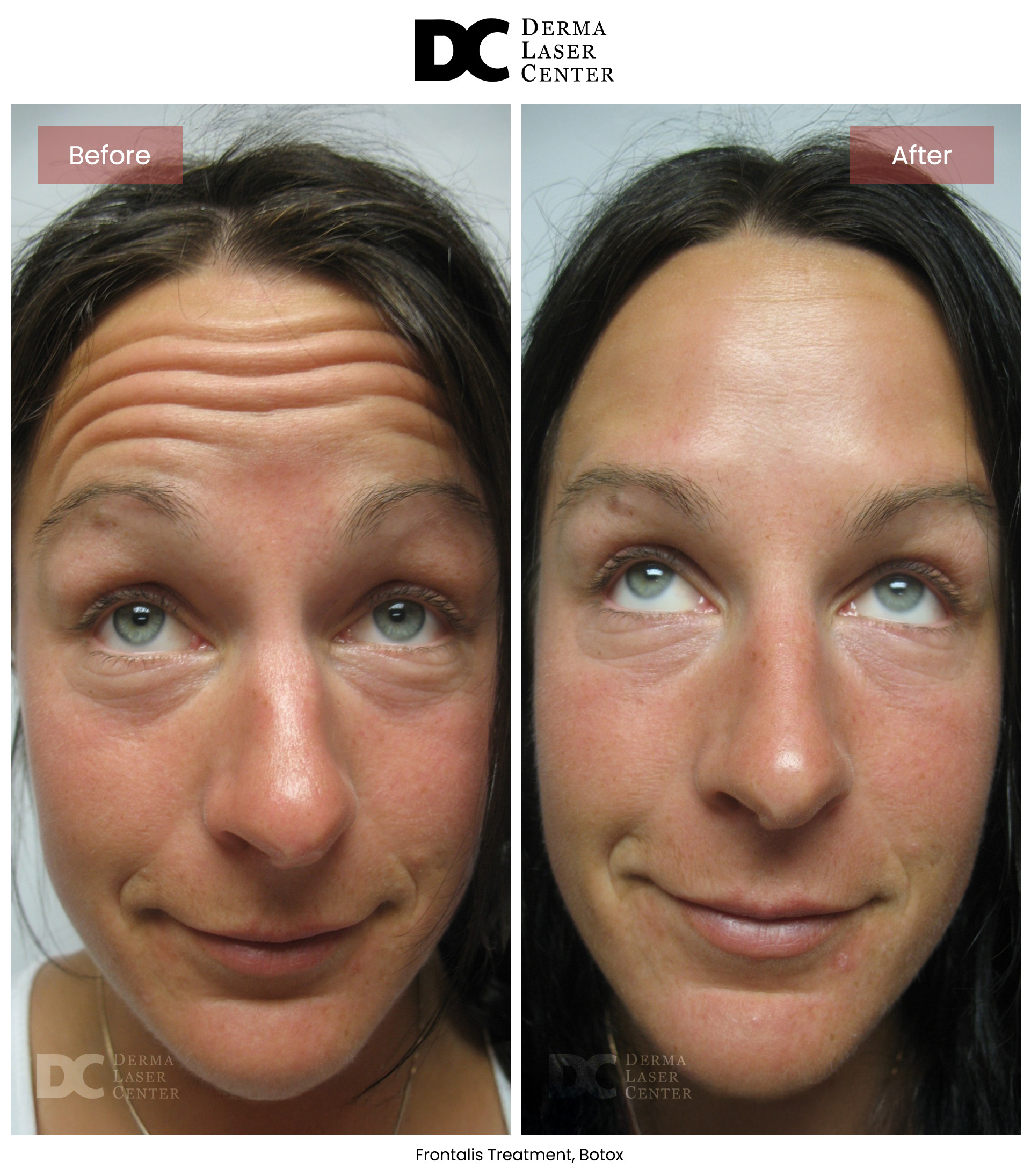 B&A Botox Image 07 V1