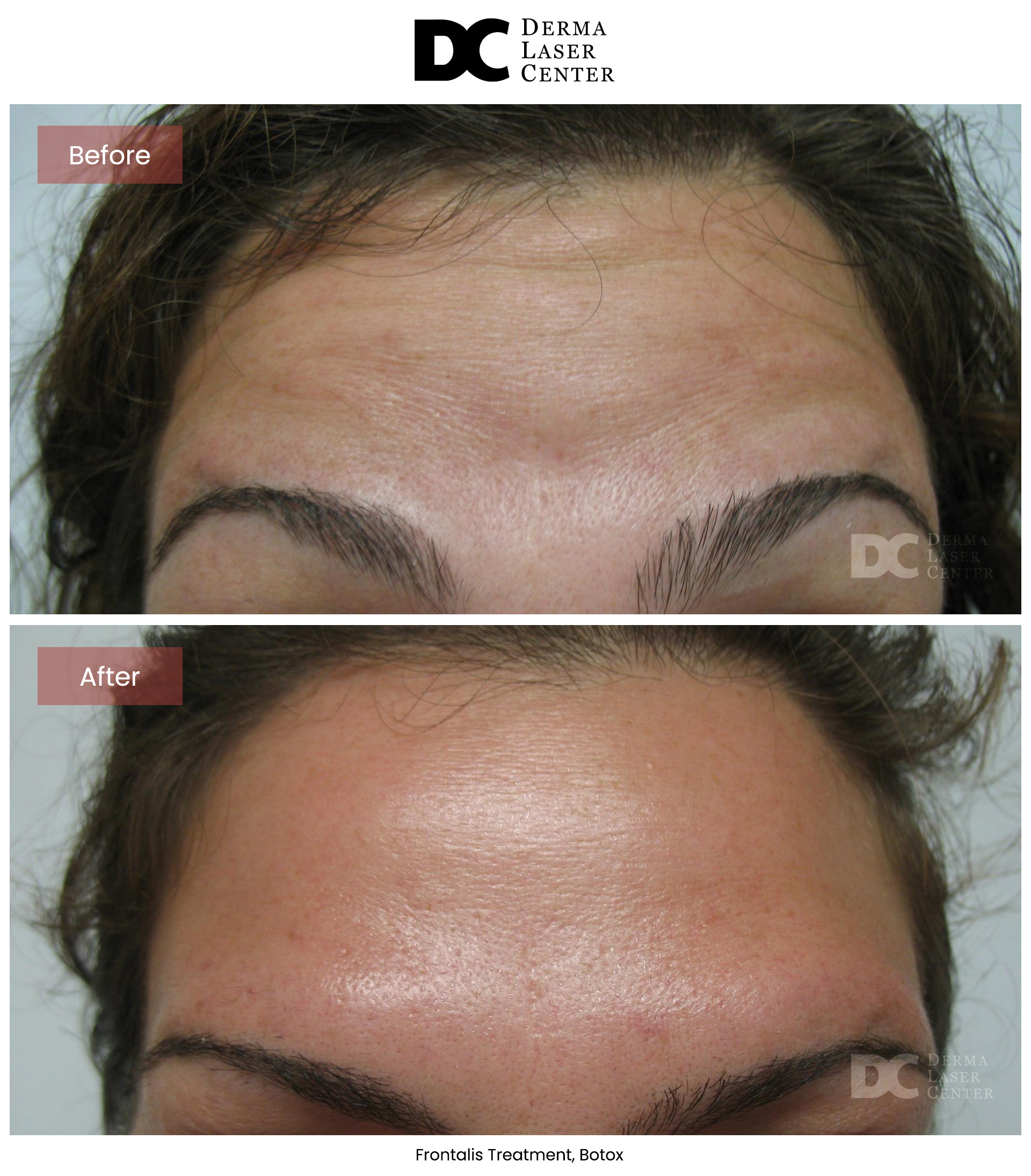 B&A Botox Image 08 V1
