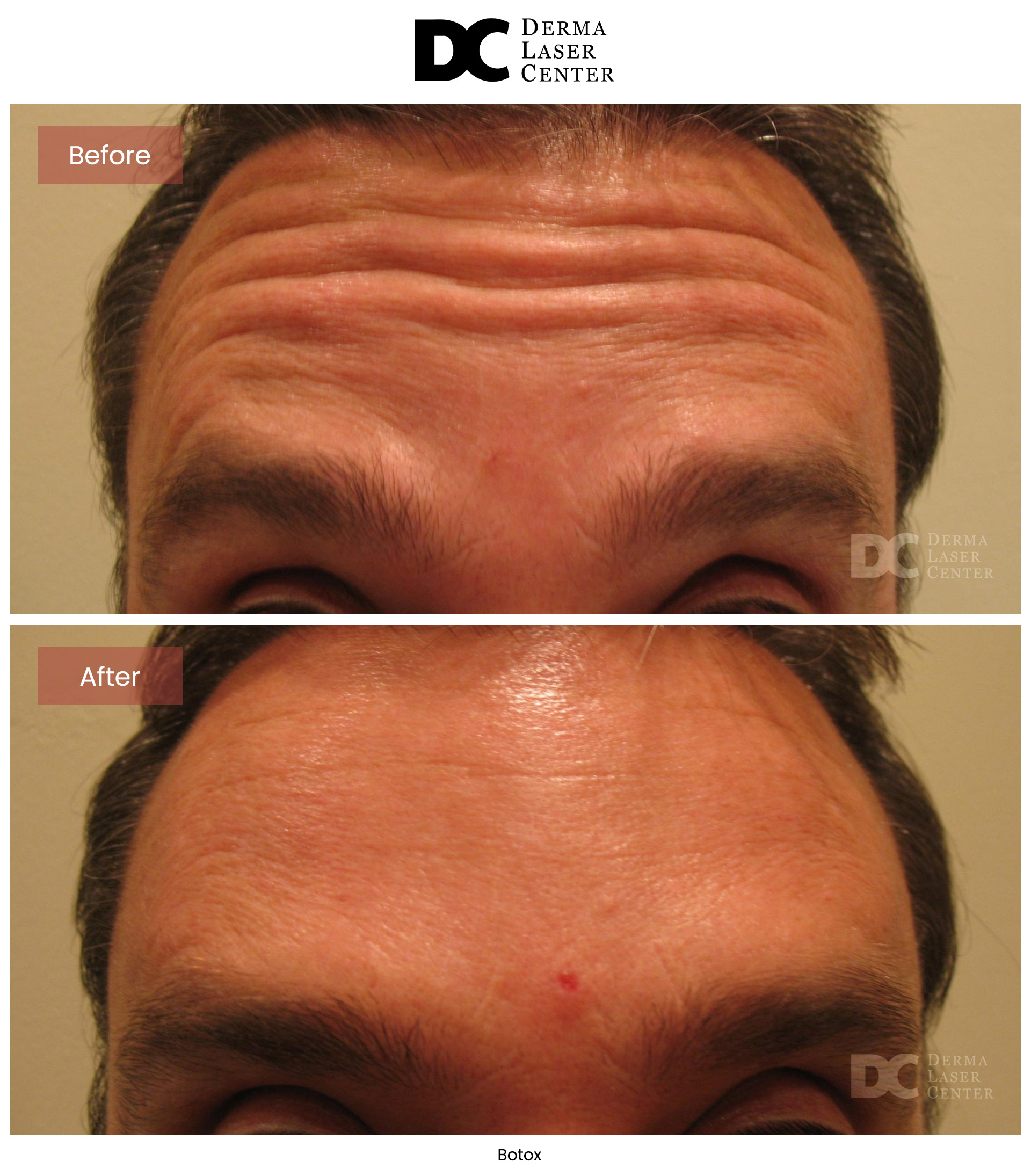 B&A Botox Image 09 V1