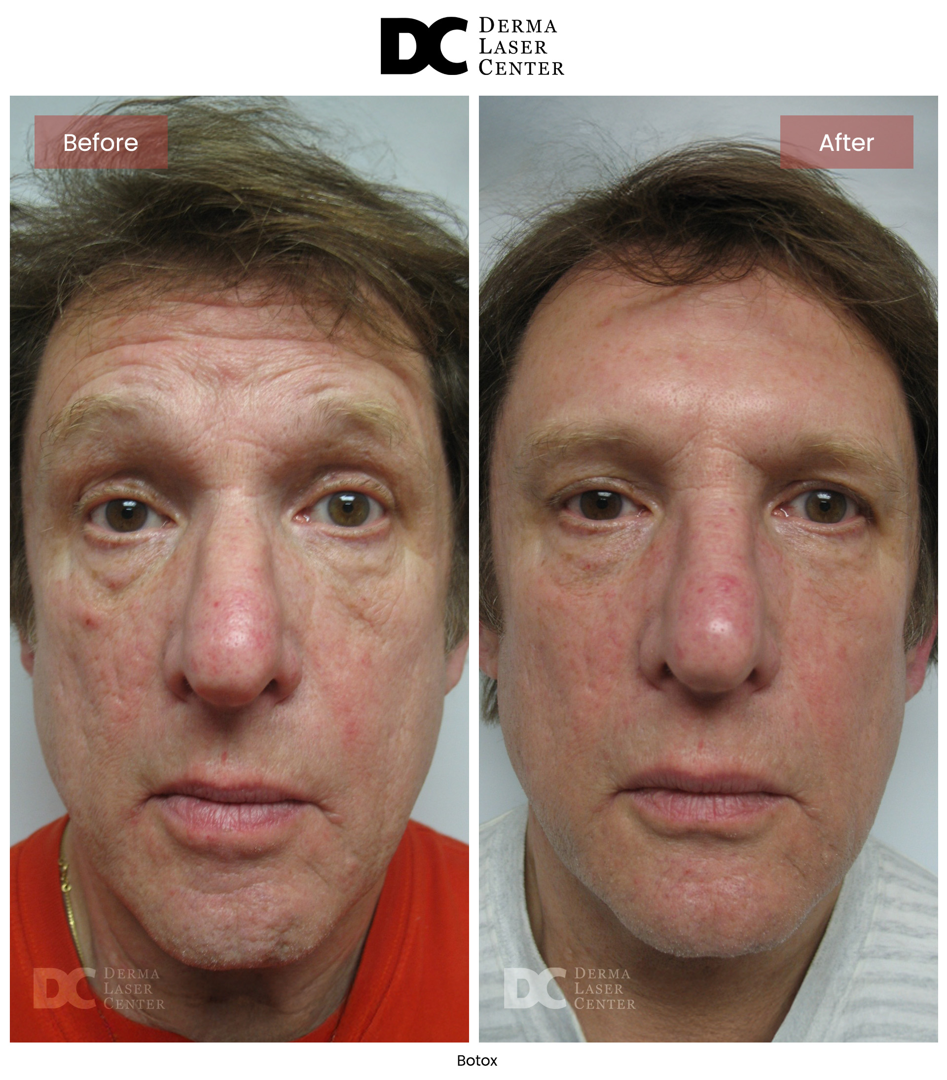 B&A Botox Image 10 V1