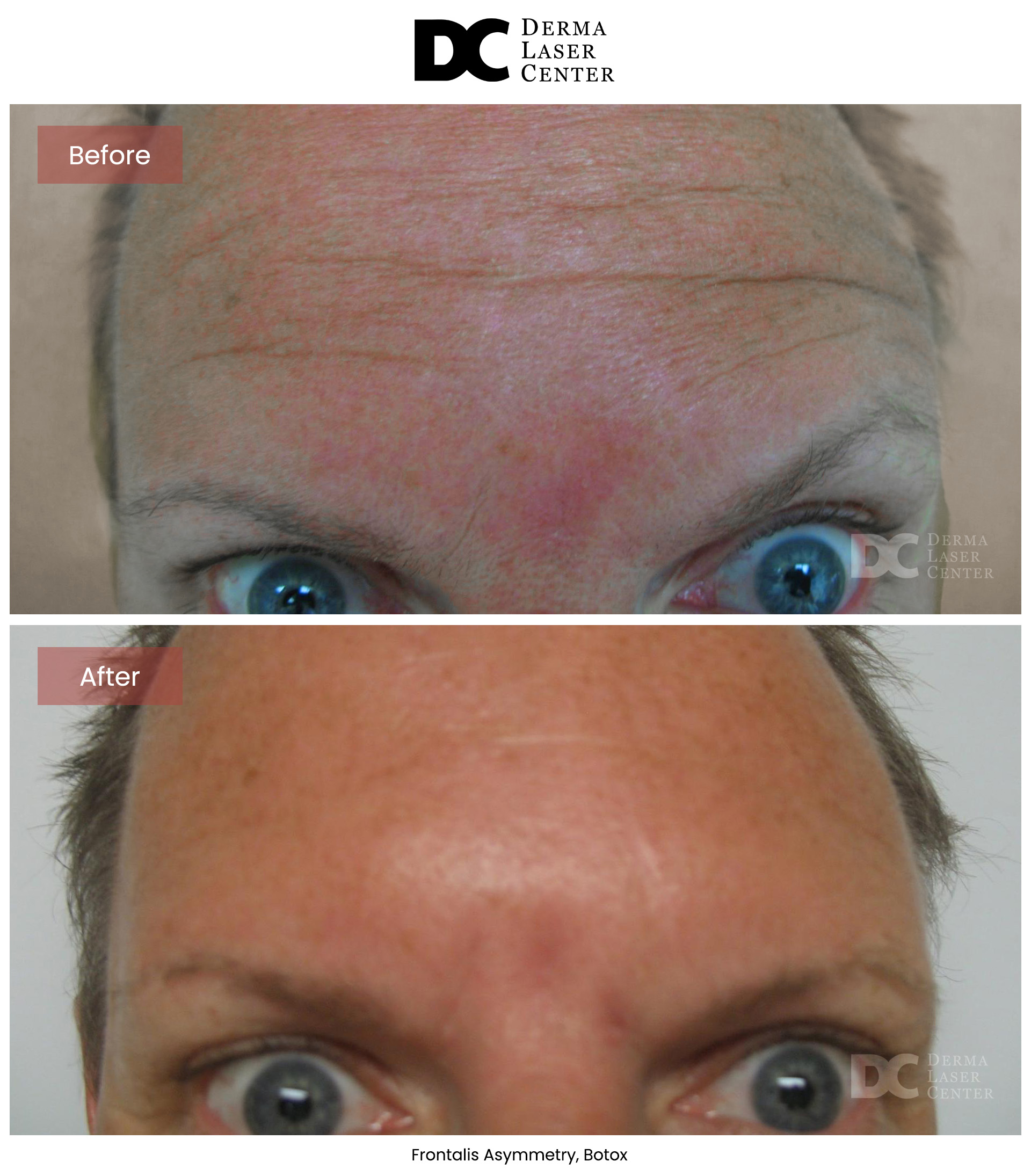 B&A Botox Image 11 V1