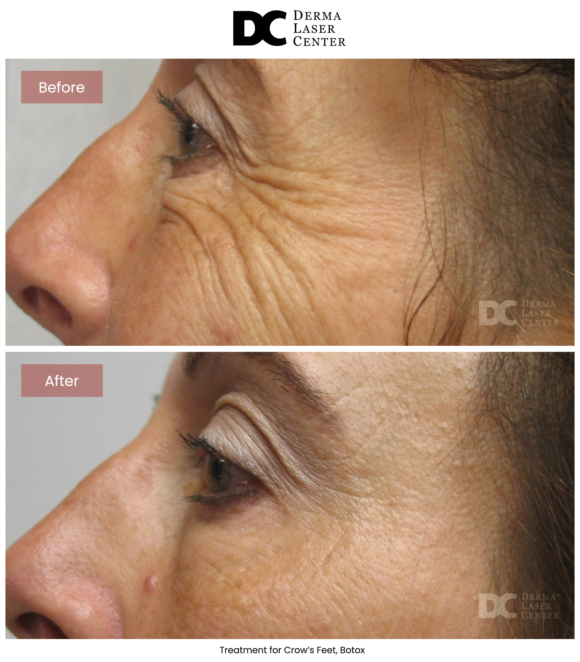B&A Botox Image 12 V1
