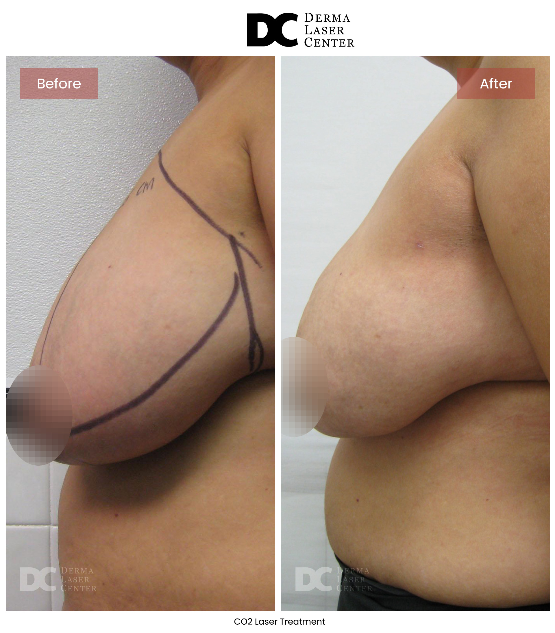 B&A Breasts Image 02 V1