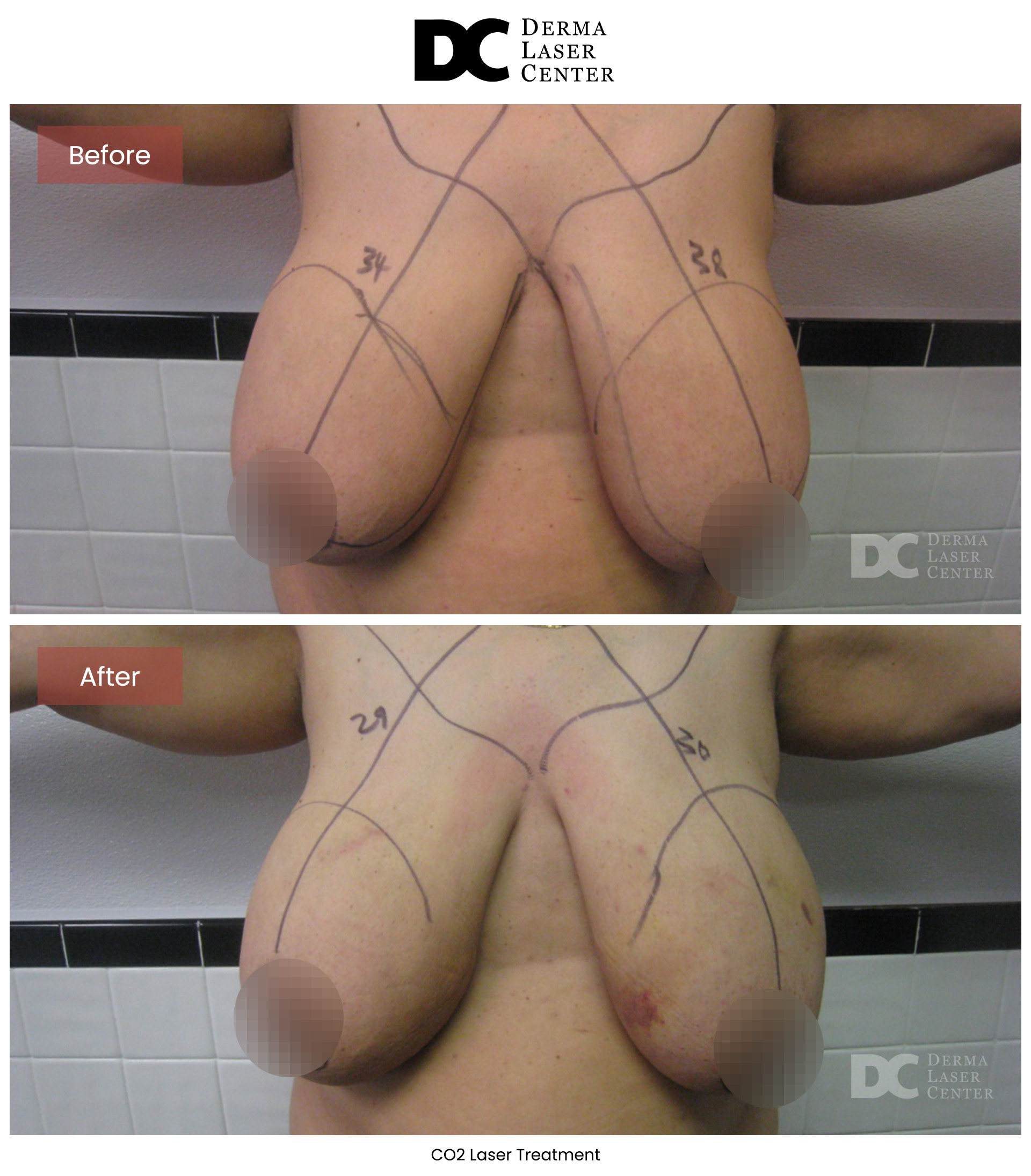 B&A Breasts Image 03 V1