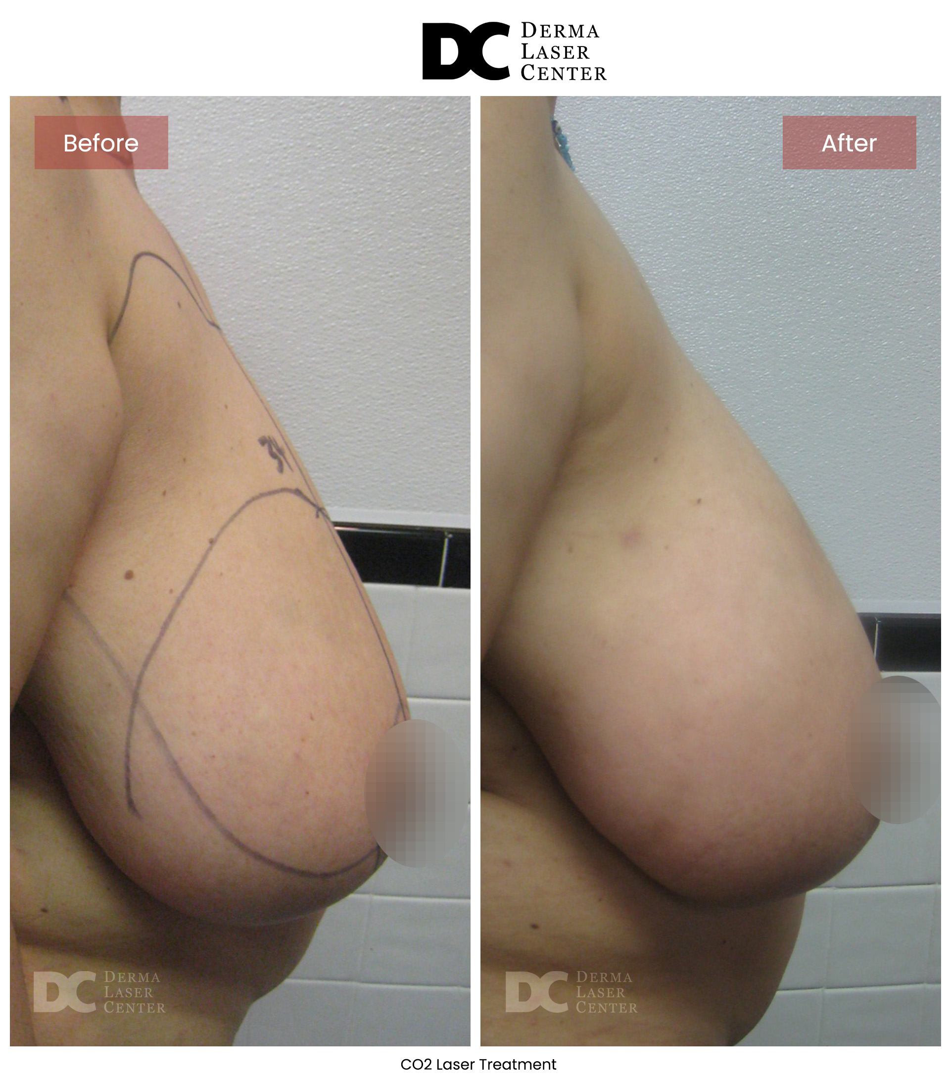 B&A Breasts Image 04 V1