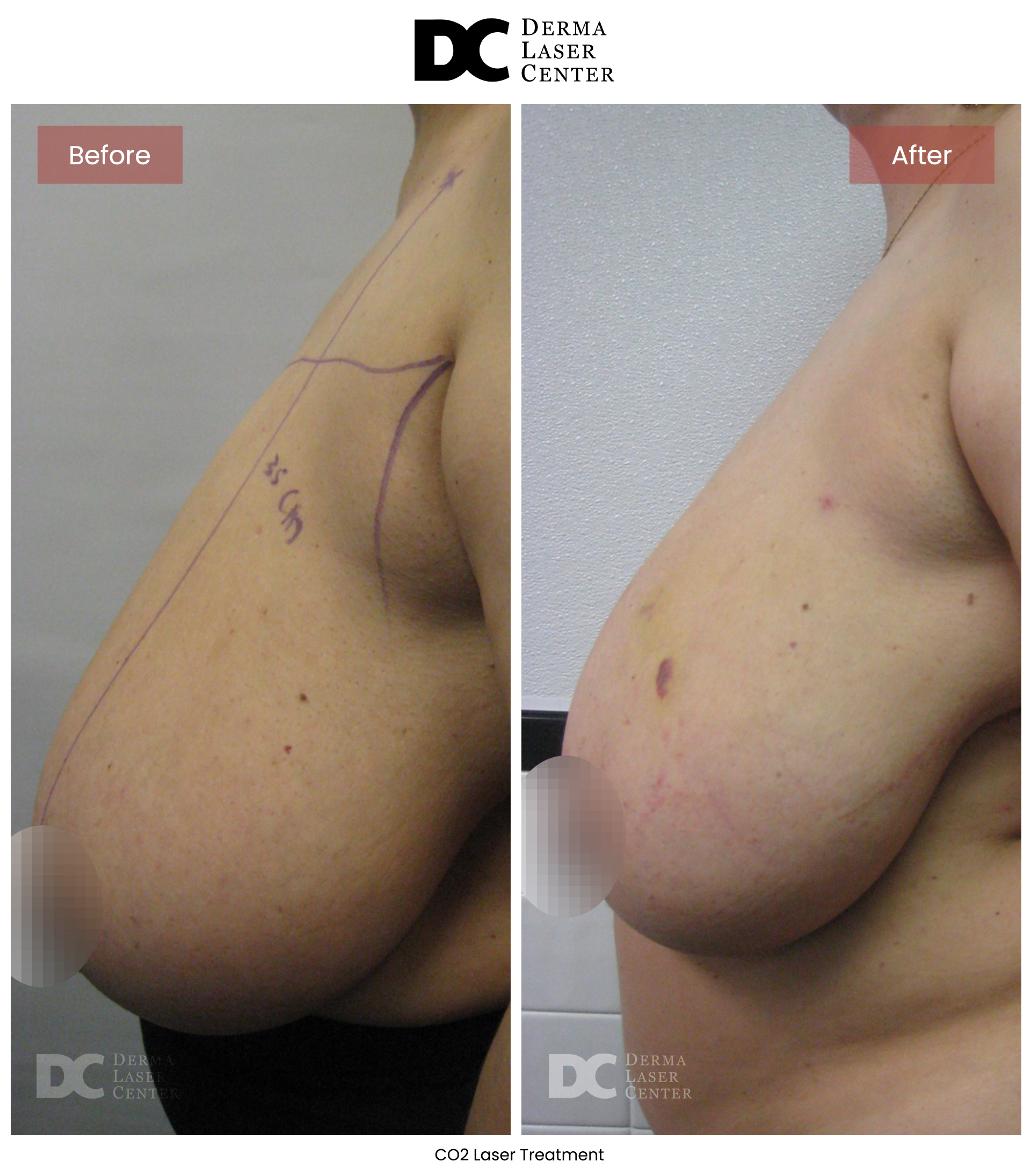 B&A Breasts Image 06 V1
