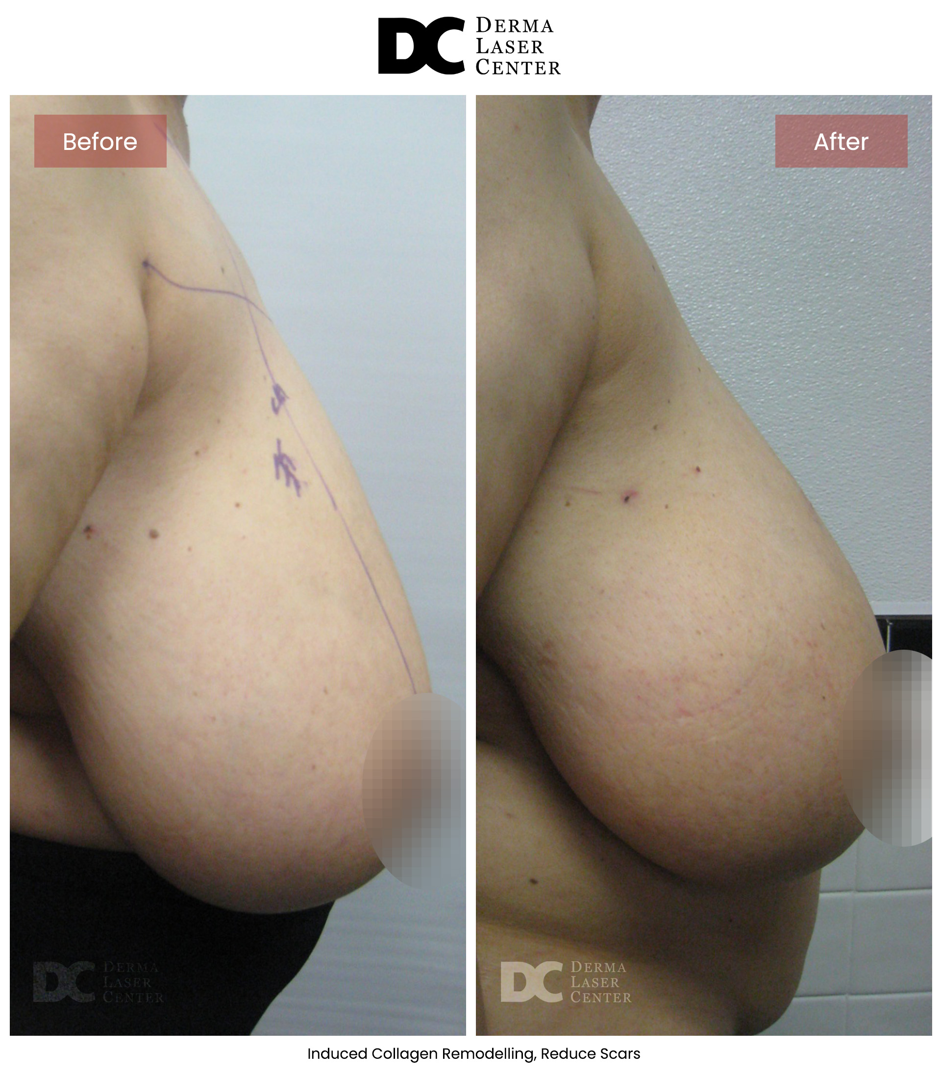 B&A Breasts Image 07 V1