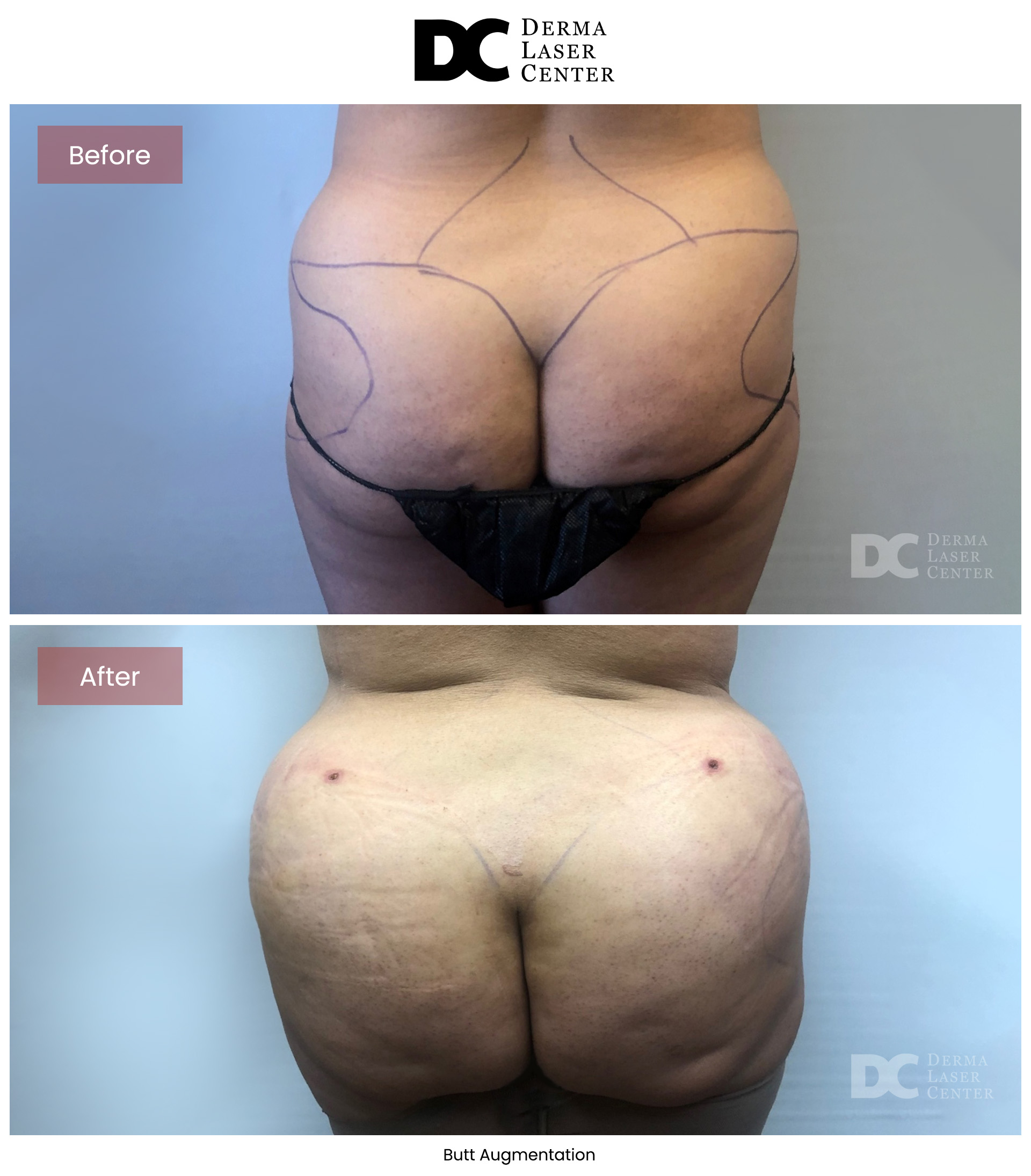B&A Butt Augm Image 01 V1