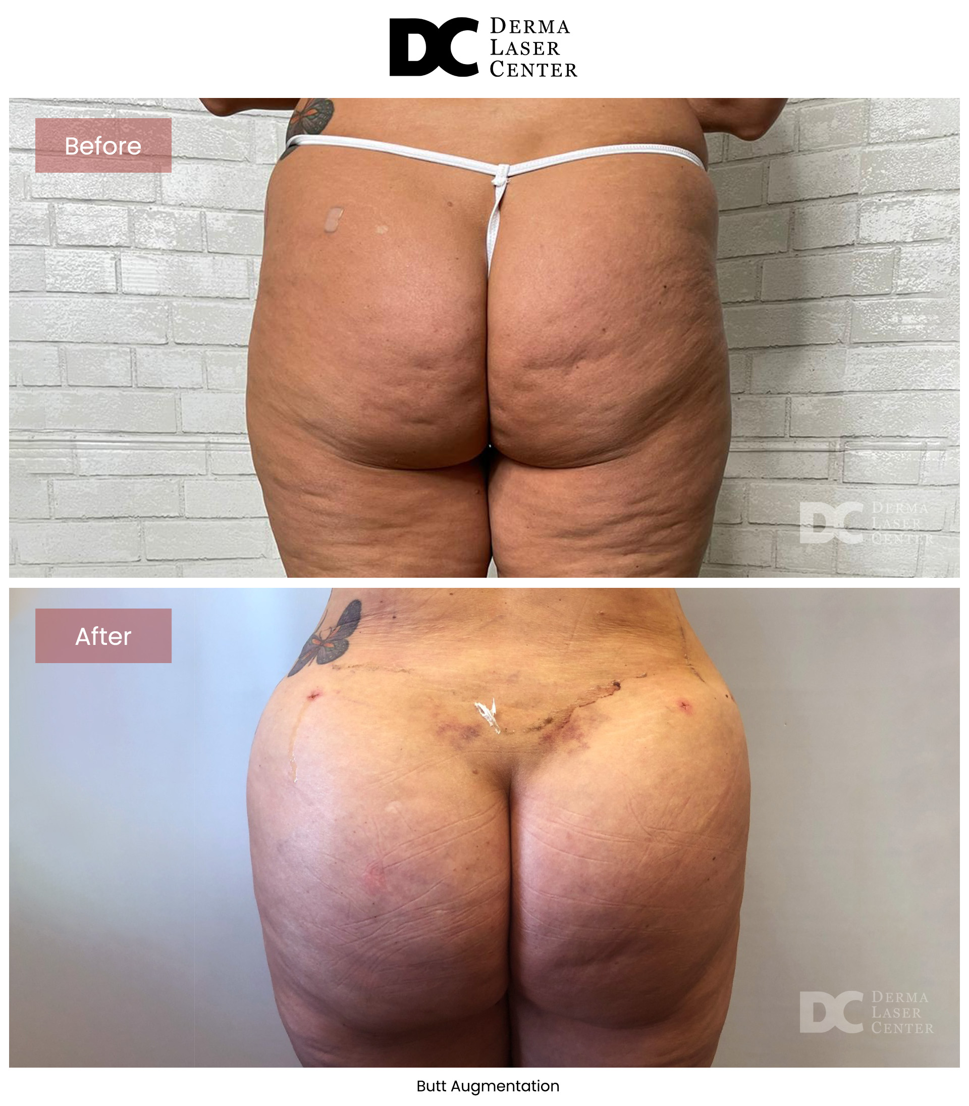 B&A Butt Augm Image 02 V1