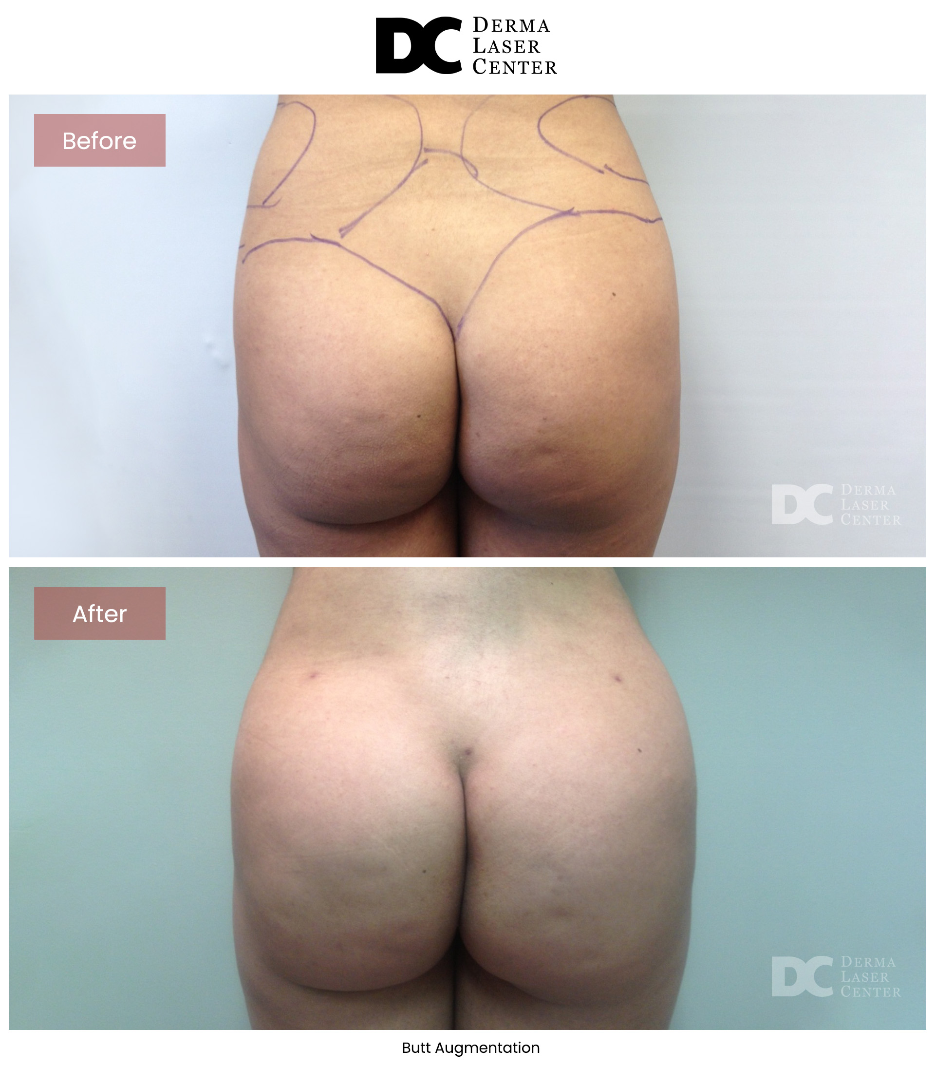 B&A Butt Augm Image 03 V1