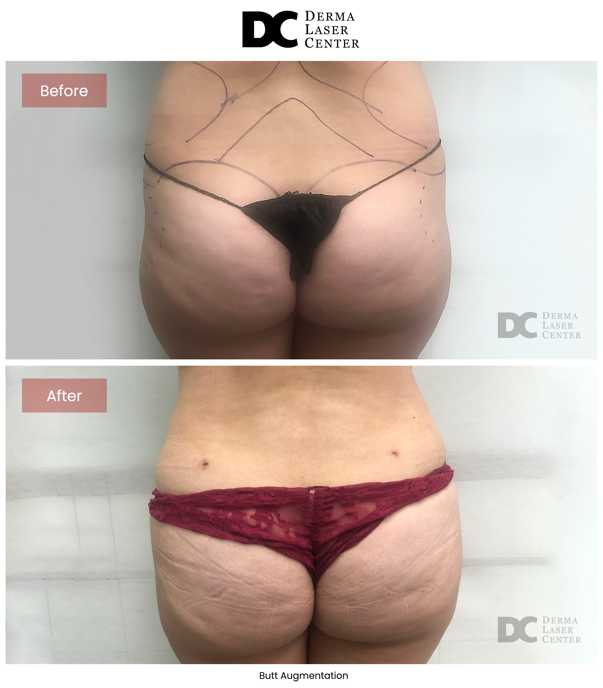 B&A Butt Augm Image 04 V1