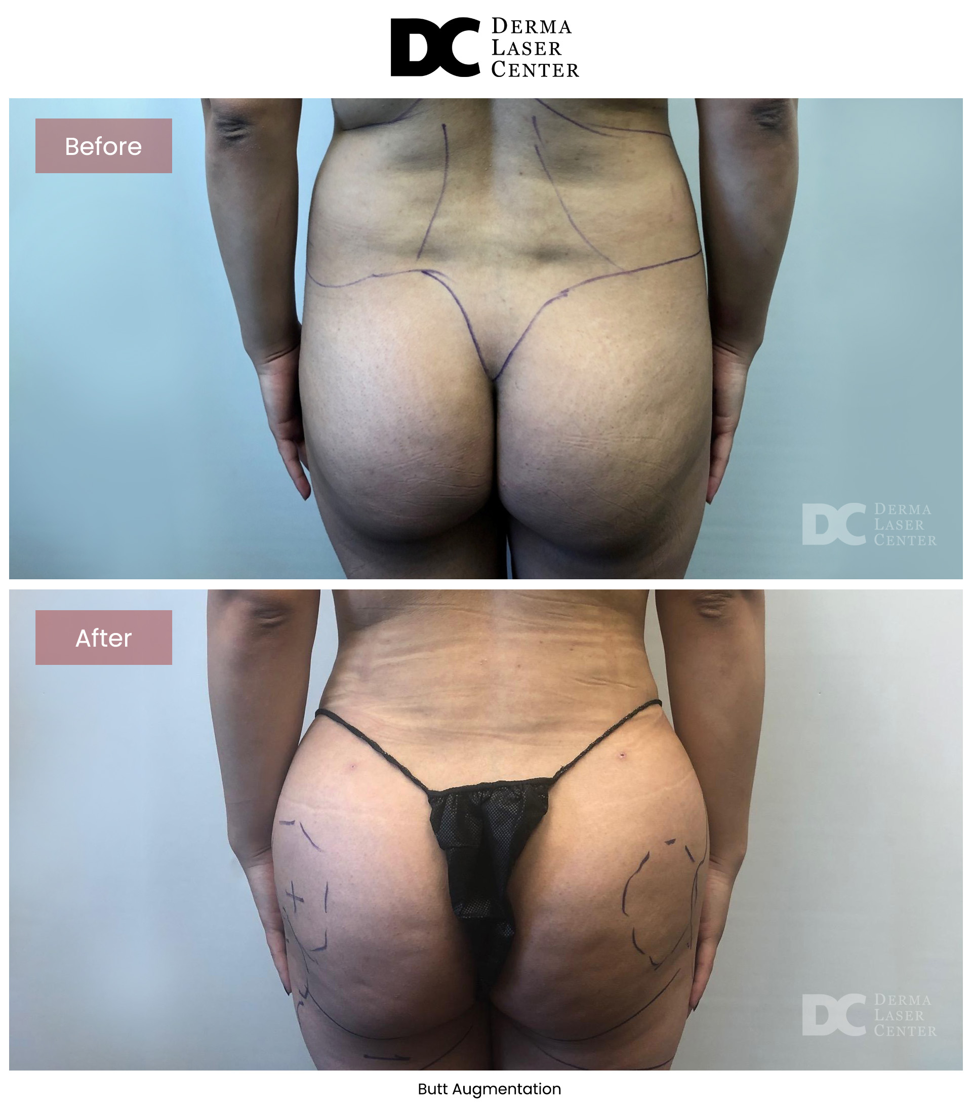 B&A Butt Augm Image 05 V1