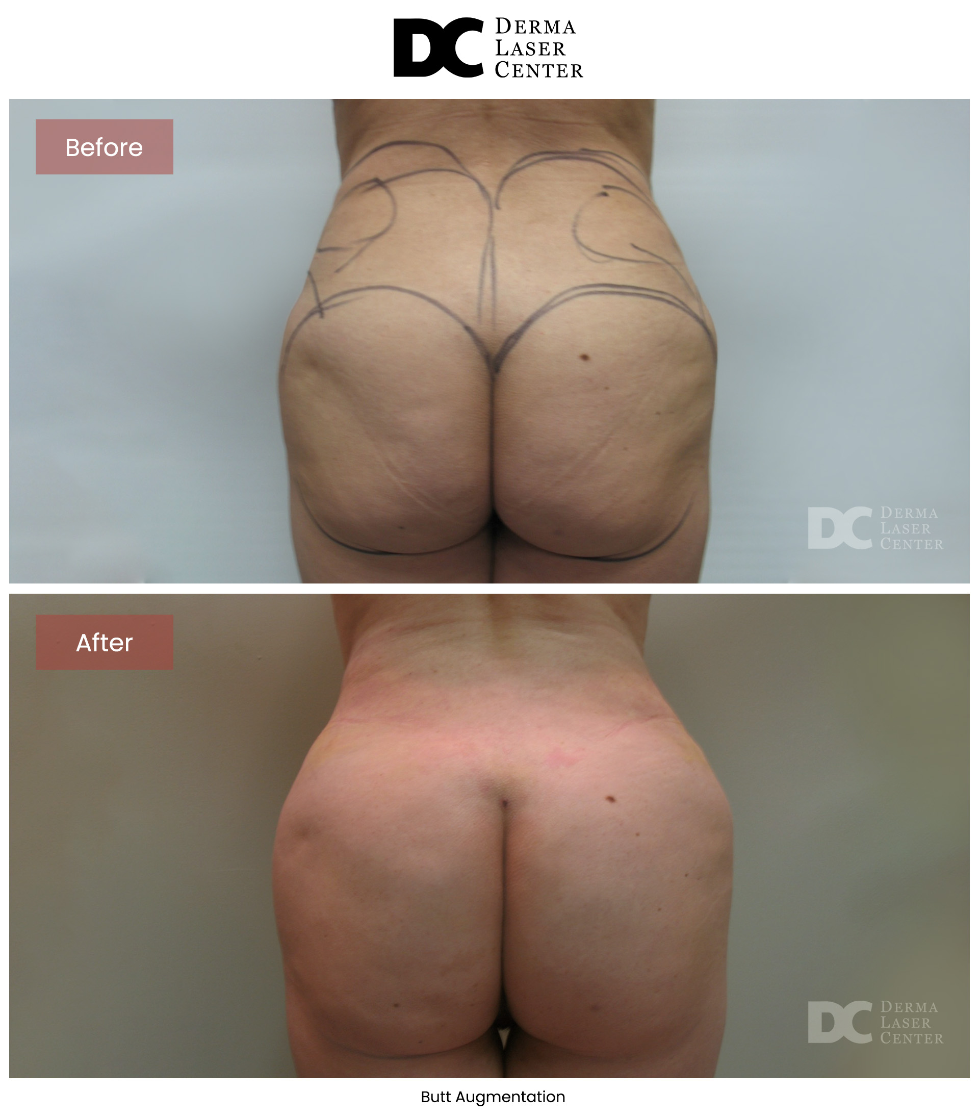 B&A Butt Augm Image 06 V1