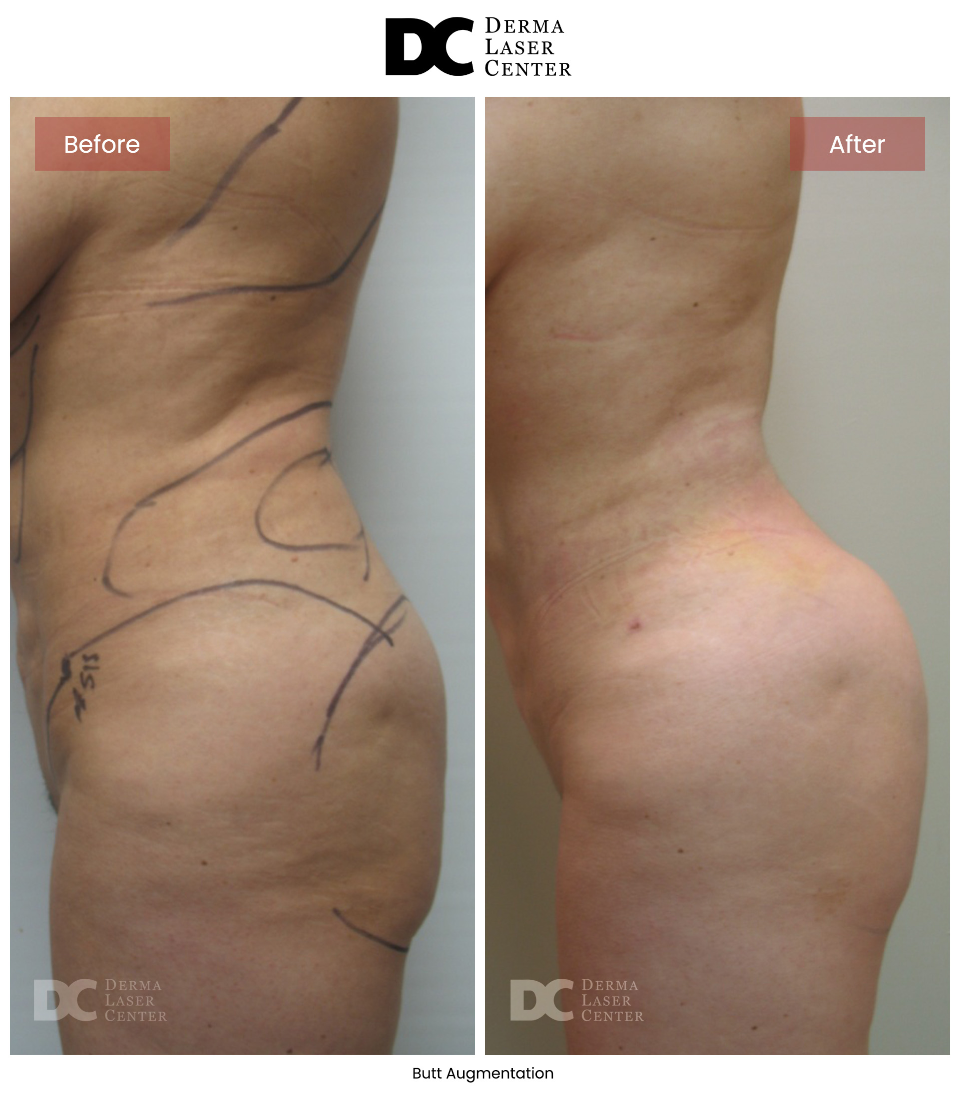 B&A Butt Augm Image 07 V1