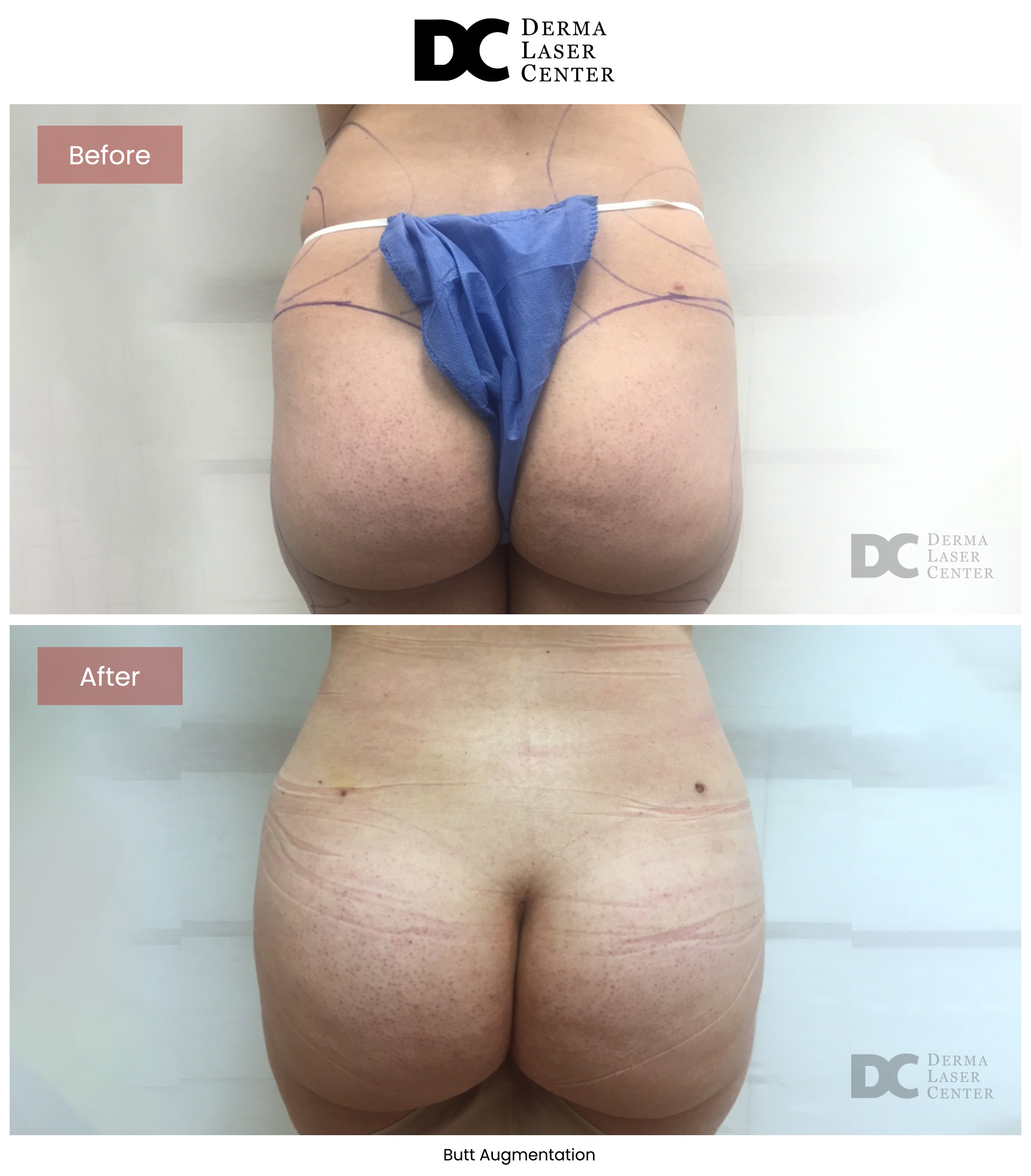 B&A Butt Augm Image 08 V1