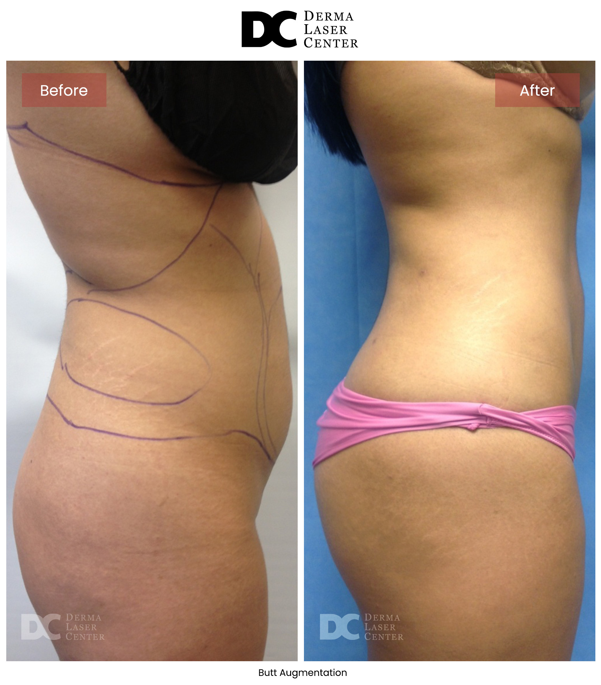 B&A Butt Augm Image 09 V1