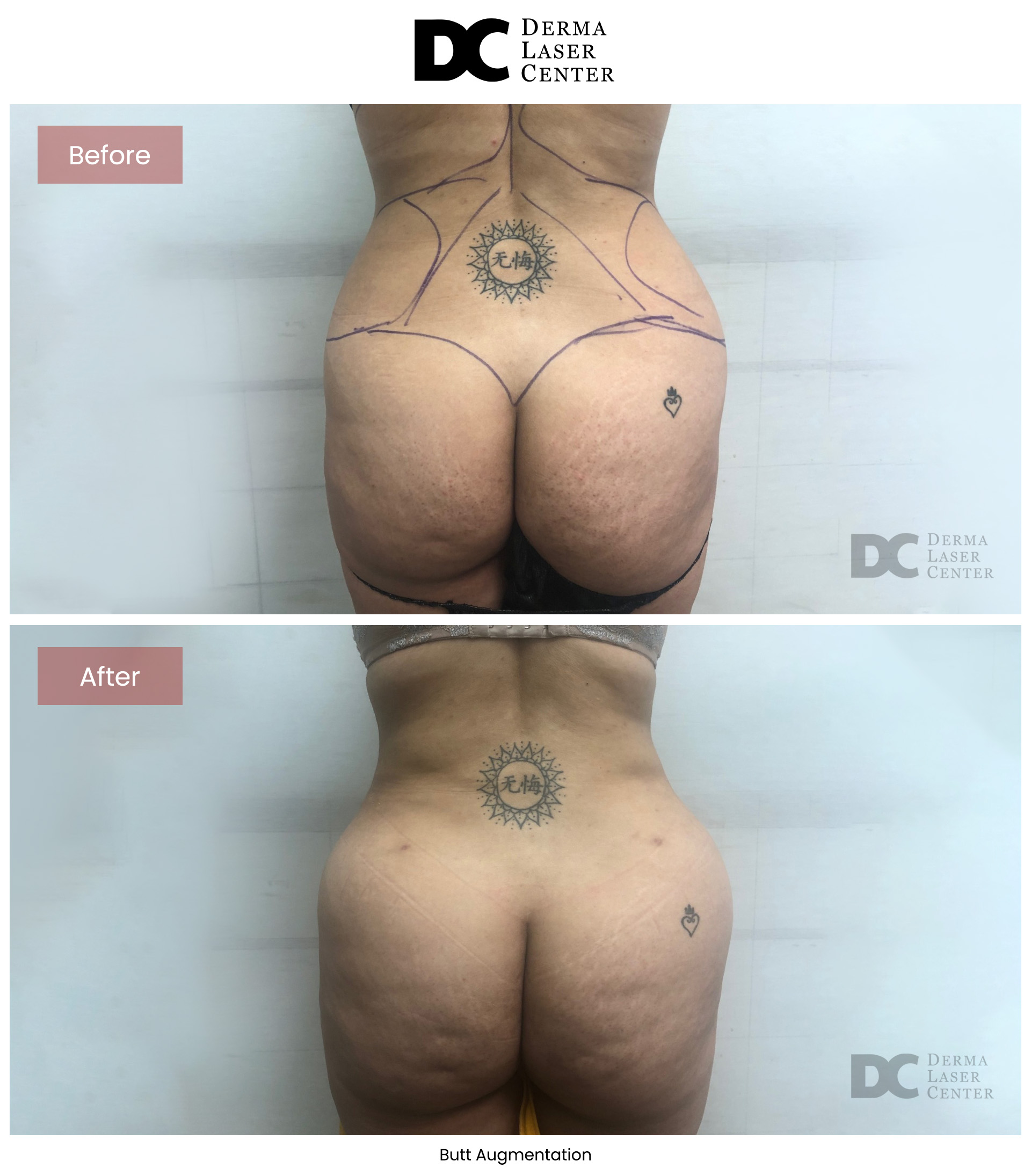 B&A Butt Augm Image 10 V1