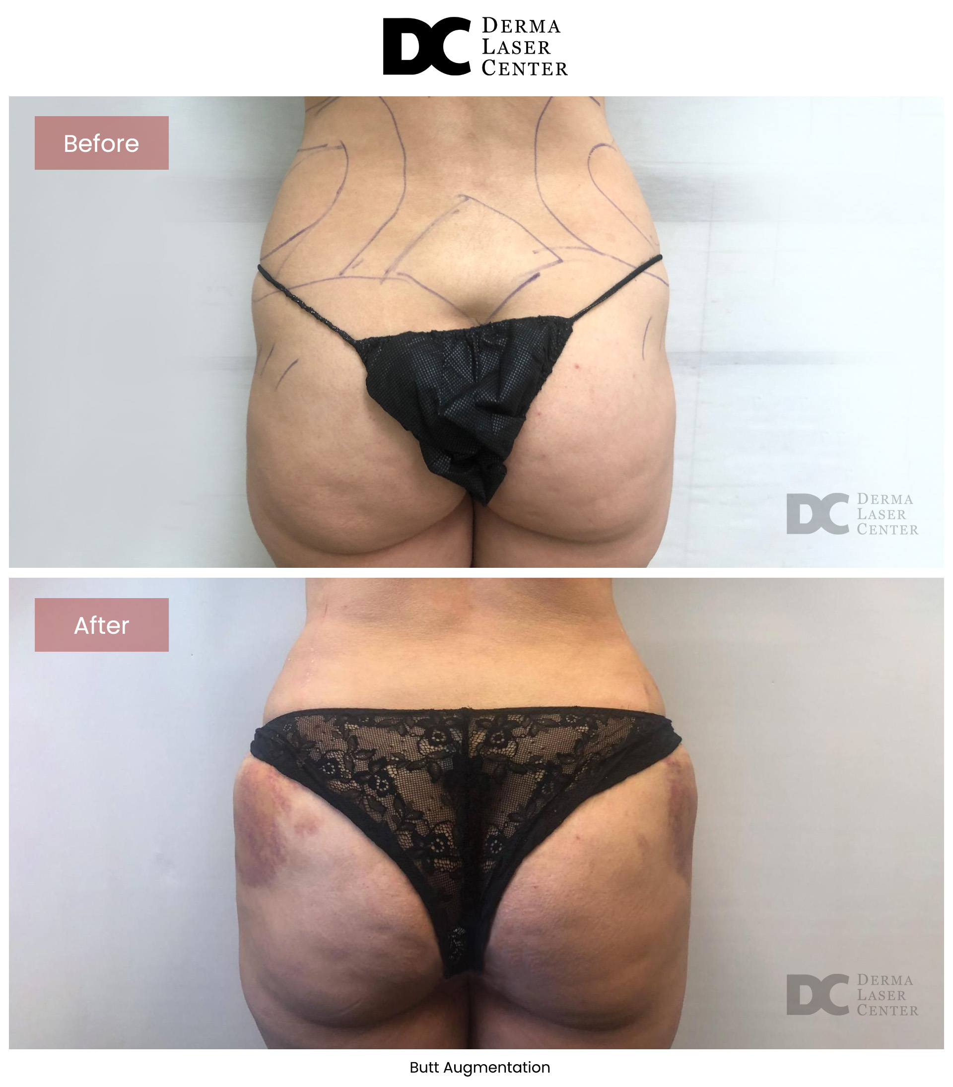 B&A Butt Augm Image 11 V1