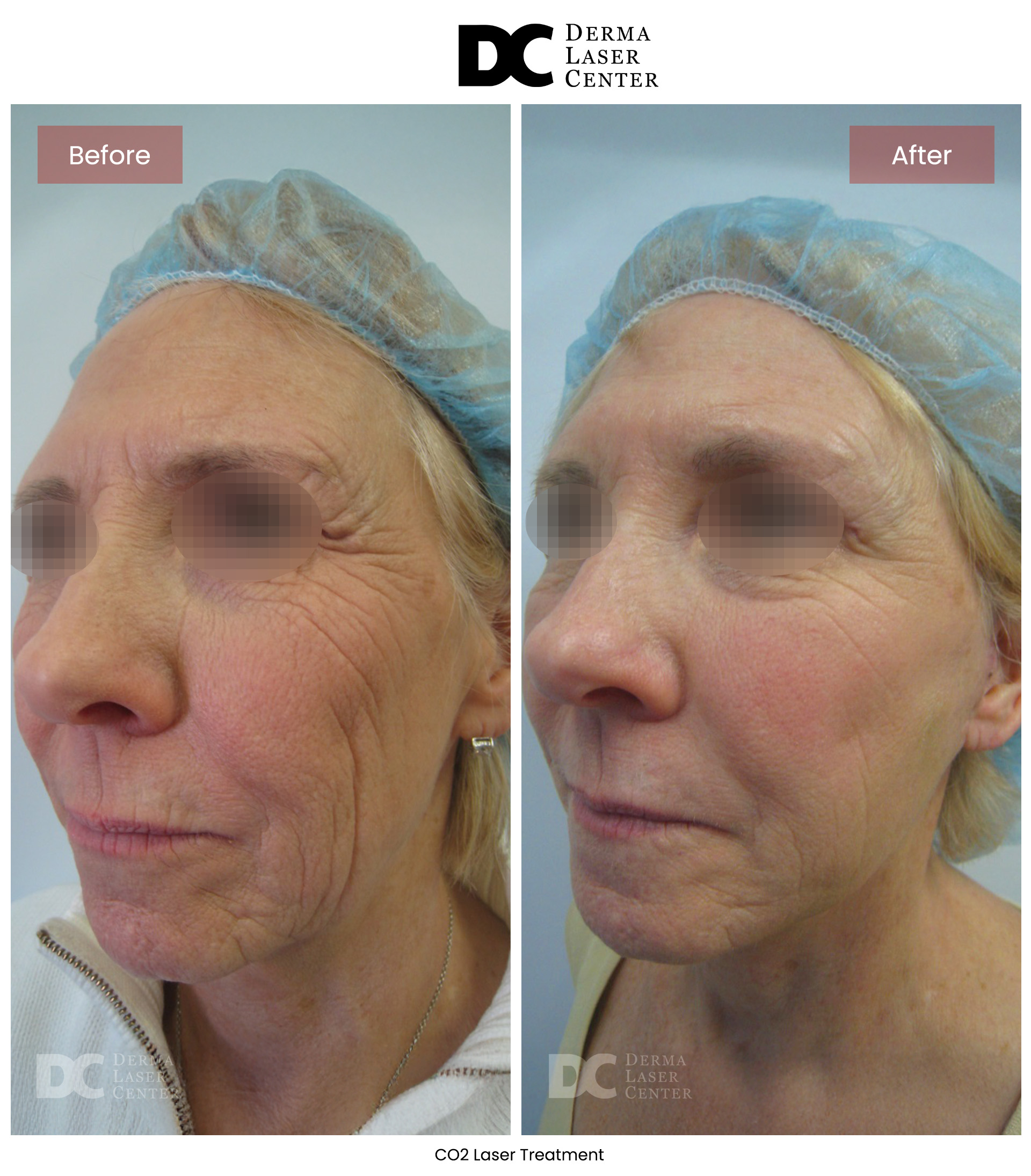 B&A CO2 Laser Image 01 V1