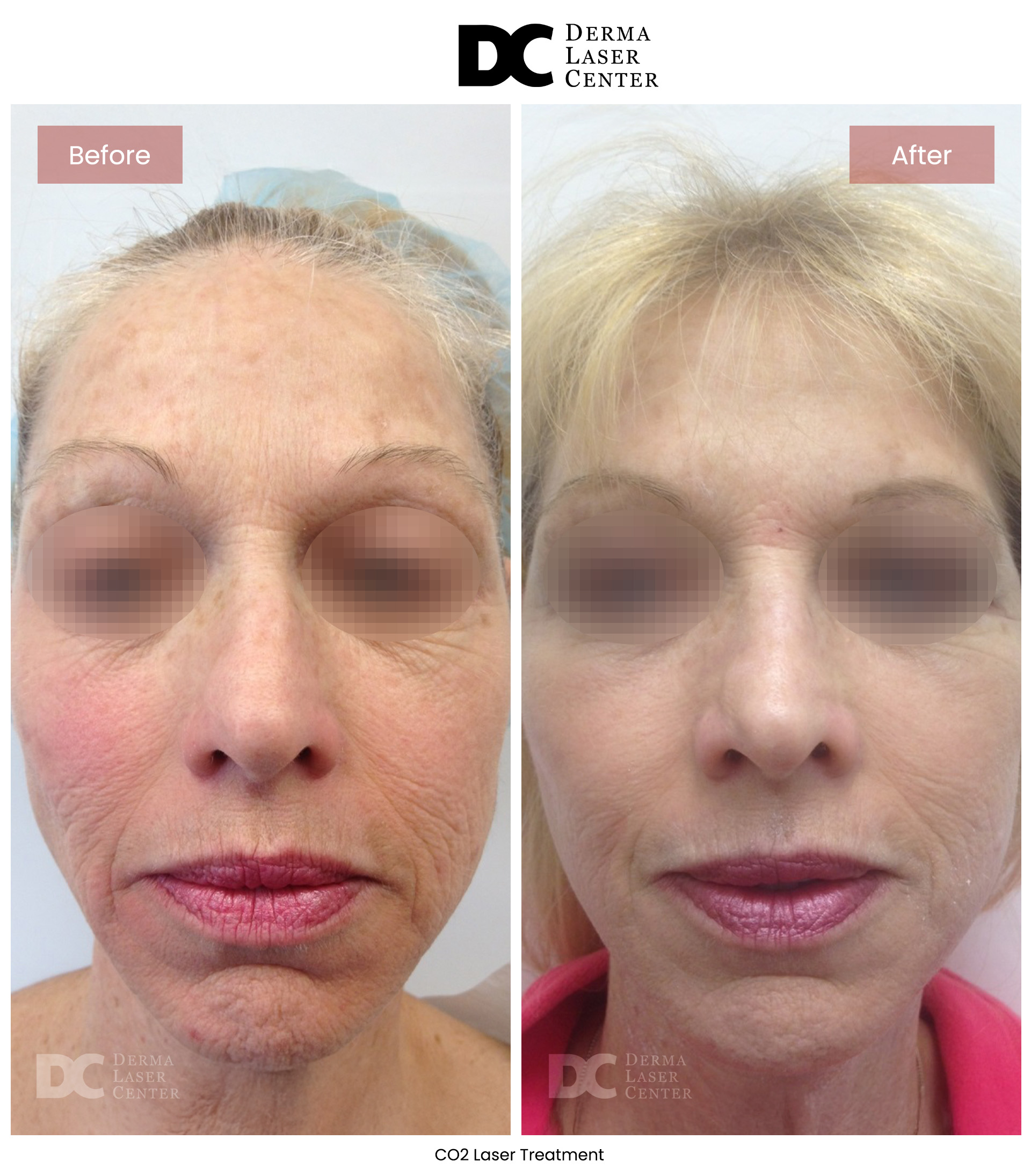 B&A CO2 Laser Image 02 V1