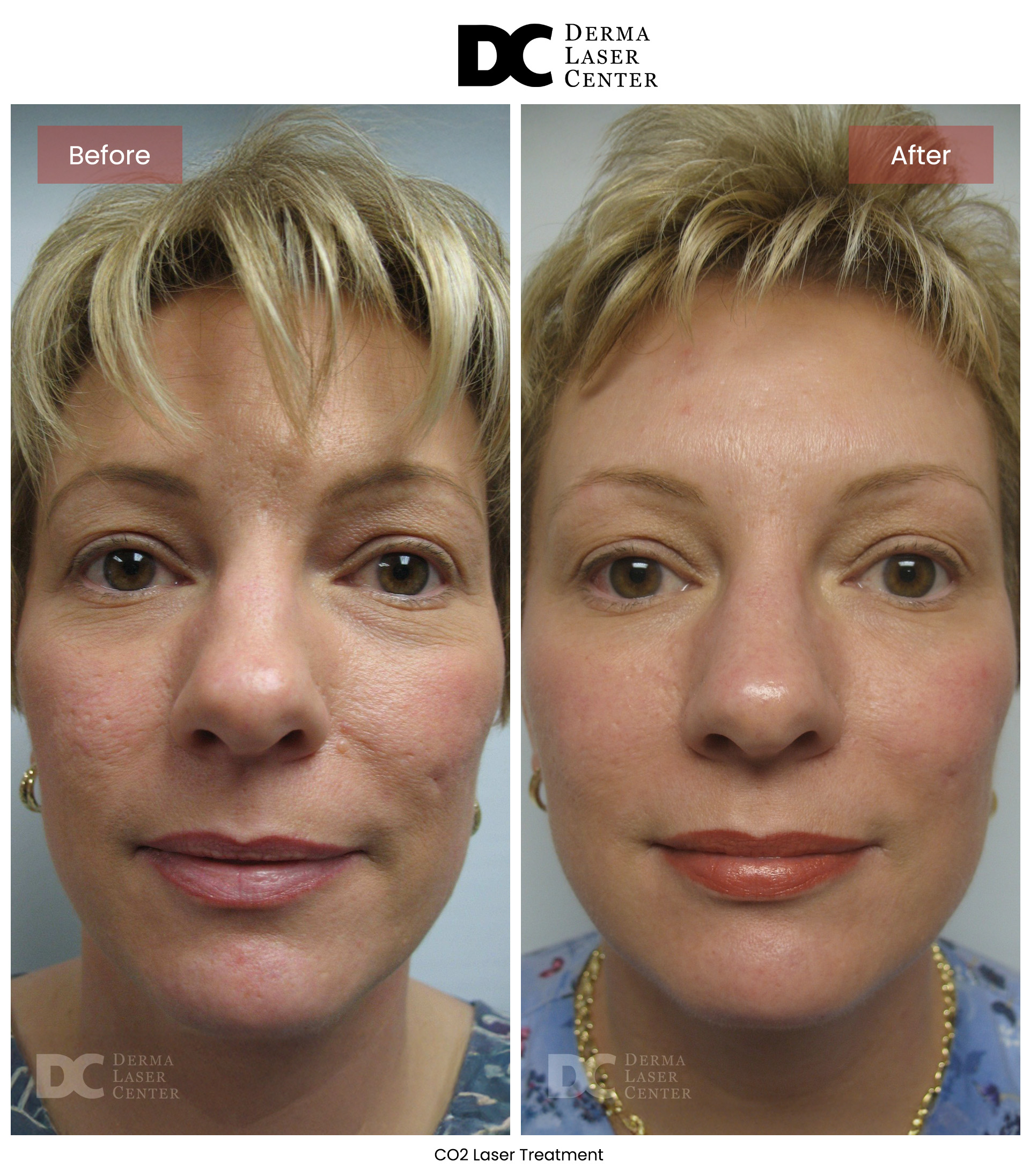 B&A CO2 Laser Image 04 V1