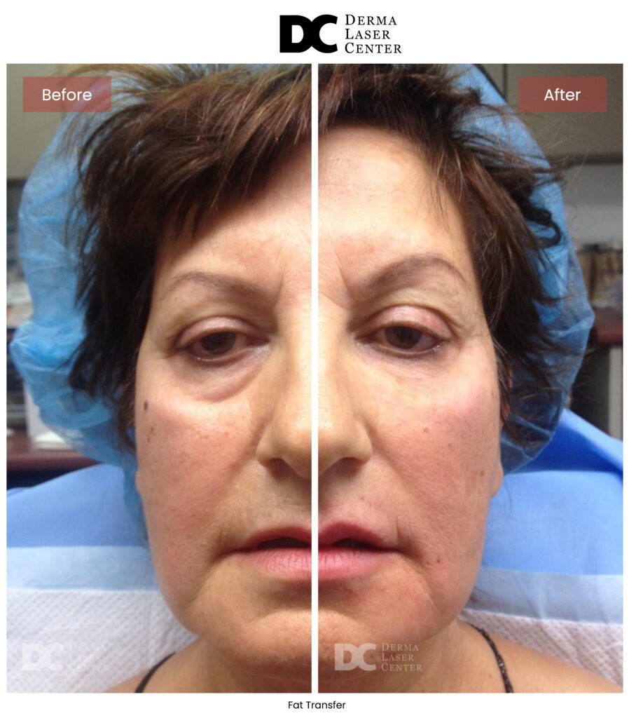B&A Fat Transfer Image 01 V1