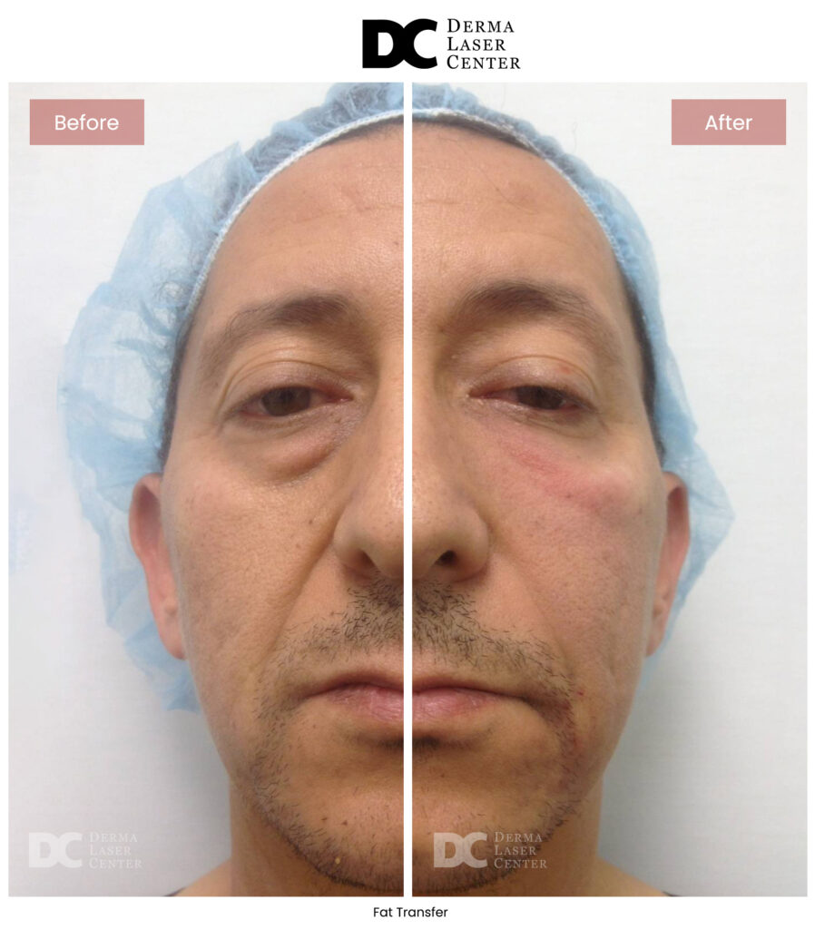 B&A Fat Transfer Image 02 V1