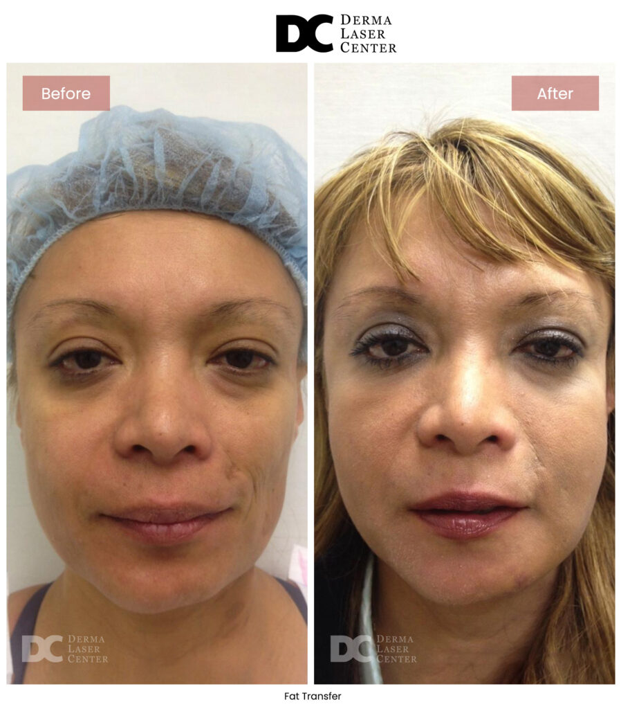 B&A Fat Transfer Image 03 V1