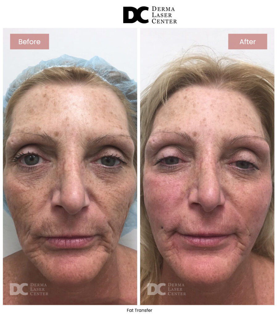 B&A Fat Transfer Image 04 V1