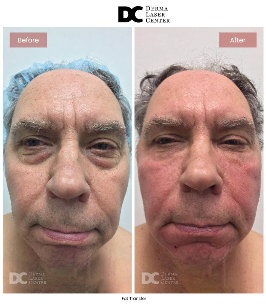 B&A Fat Transfer Image 05 V1