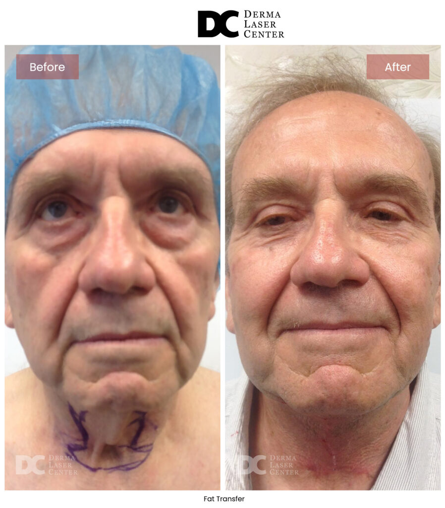 B&A Fat Transfer Image 06 V1