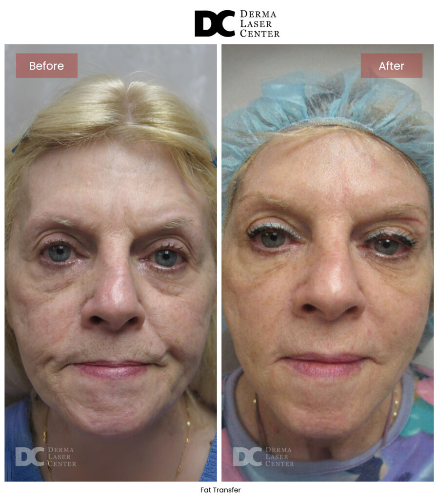 B&A Fat Transfer Image 07 V1