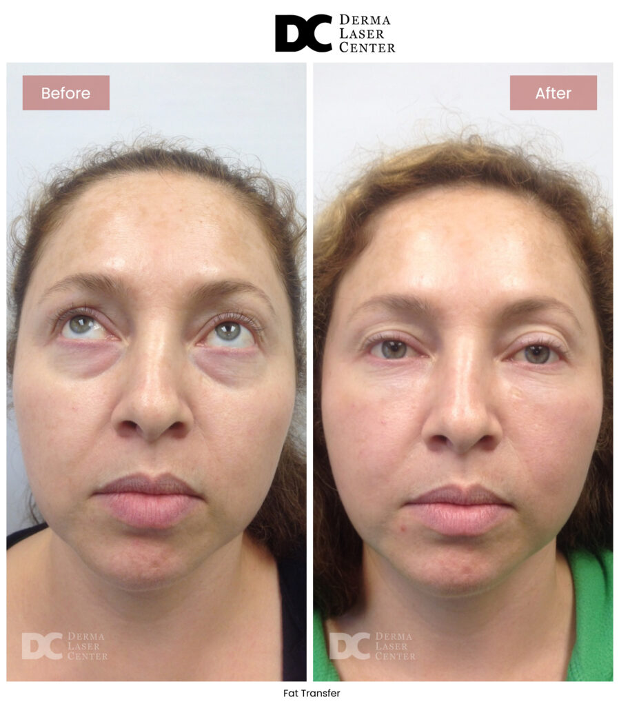 B&A Fat Transfer Image 08 V1