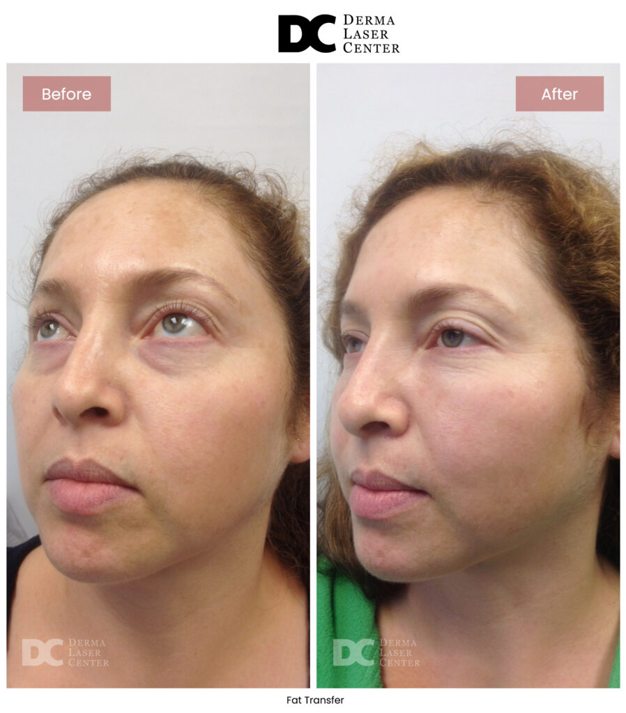 B&A Fat Transfer Image 09 V1