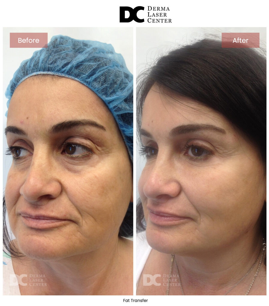 B&A Fat Transfer Image 10 V1
